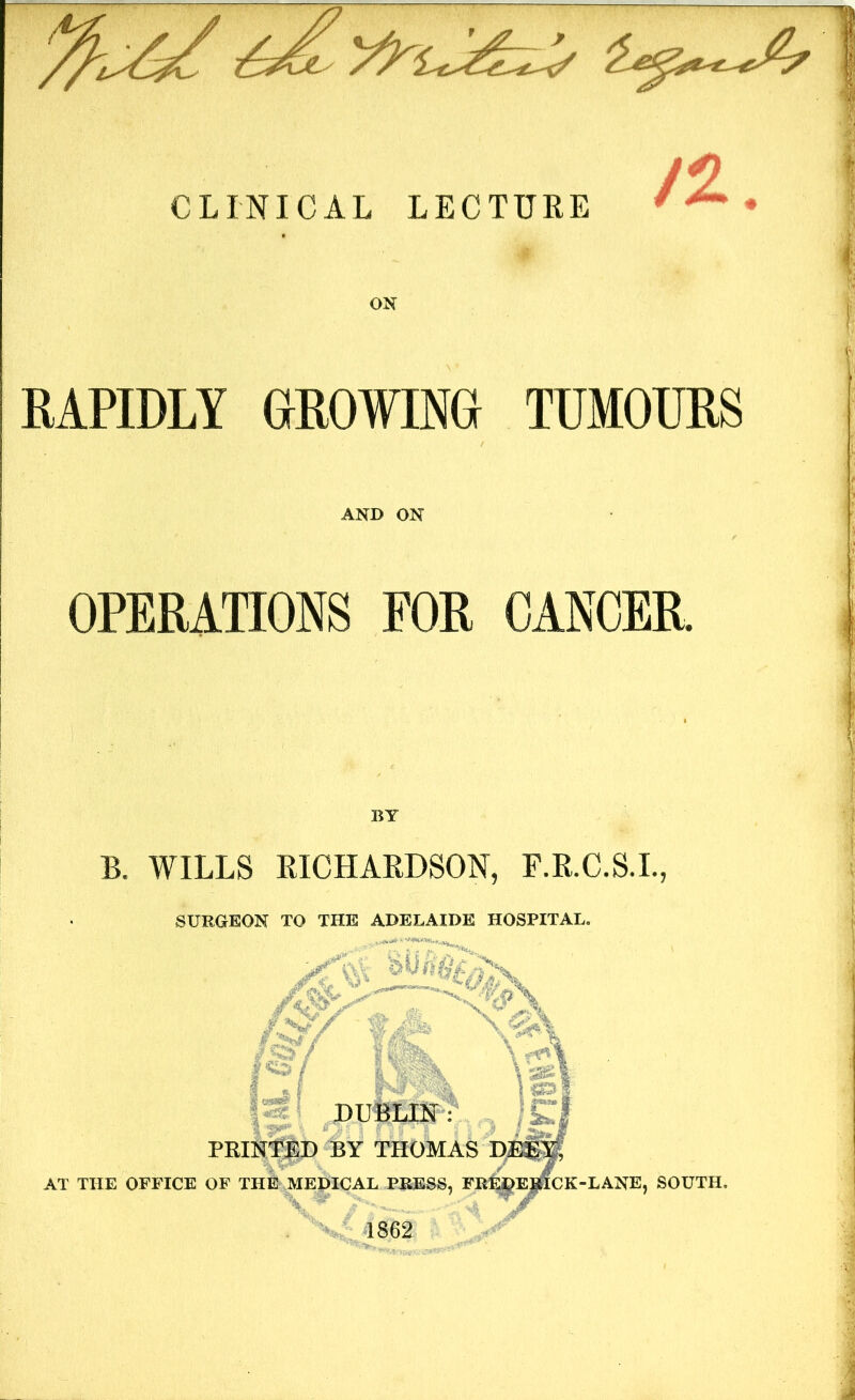 CLINICAL LECTURE RAPIDLY GROWING TUMOURS AND ON OPERATIONS FOR CANCER BY B. WILLS RICHARDSON, F.R.C.S.I., SURGEON TO THE ADELAIDE HOSPITAL. Vas* | * * 1 & 1 DUBLIN: PRINTED BY THOMAS Di AT THE OFFICE OF THE MEDICAL PRESS, FRt$E|ficK-LANE, SOUTH. XT >-—4 w* 1862