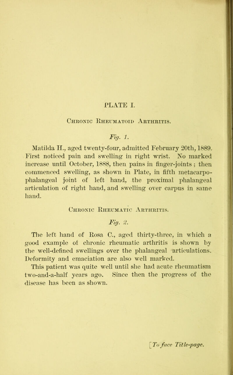 PLATE I. Chronic Eheumatoid Arthritis. Fig. 1. Matilda H., aged twenty-four, admitted February 20th, 1889„ First noticed pain and swelling in right wrist. No marked increase until October, 1888, then pains in finger-joints ; then commenced swelling, as shown in Plate, in fifth metacarpo- phalangeal joint of left hand, the proximal iihalangeal articulation of right hand, and swelling over carpus in same hand. Chronic Eheumatic Arthritis. Fkj. 2. The left hand of Eosa C., aged thirty-three, in which a good example of chronic rheumatic arthritis is shown by the well-defined swellings over the phalangeal articulations. Deformity and emaciation are also well marked. This patient was quite well until she had acute rheumatism two-and-a-half years ago. Since then the progress of the disease has been as shown. [ To face Title-page,