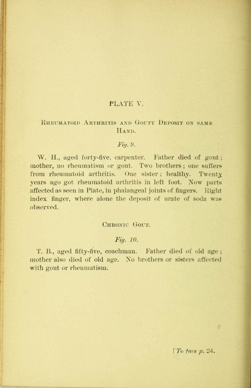 PLATE Rheumatoid Arthritis axd Gouty Deposit on same Hand. Fig, 9. W. H., aged forty-tive, carpenter. Father died of gout; mother, no rheumatism or gout. Two brothers ; one suffers from rheumatoid arthritis. One sister; healthy. Twenty years ago got rheumatoid arthritis in left foot. Now parts affected as seen in Plate, in phalangeal joints of fingers. Right index finger, wliere alone the deposit of urate of soda was observed. Chronic Gout. Fig. 10. T. B., aged fifty-five, coachman. Father died of old age; mother also died of old age. No brothers or sisters affected with gout or rheumatism.