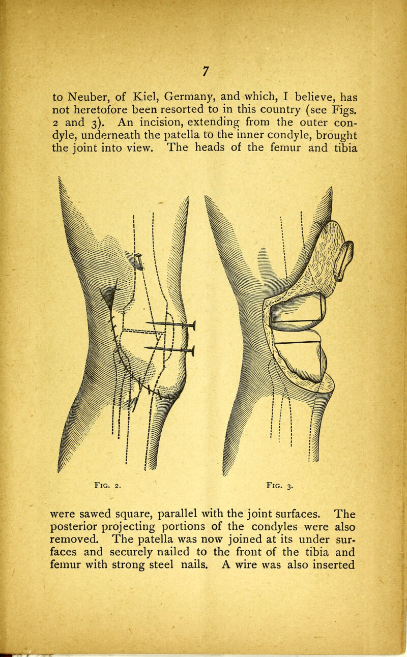 to Neuber, of Kiel, Germany, and which, I believe, has not heretofore been resorted to in this country (see Figs. 2 and 3). An incision, extending from the outer con- dyle, underneath the patella to the inner condyle, brought the joint into view. The heads of the femur and tibia were sawed square, parallel with the joint surfaces. The posterior projecting portions of the condyles were also removed. The patella was now joined at its under sur- faces and securely nailed to the front of the tibia and femur with strong steel nails. A wire was also inserted