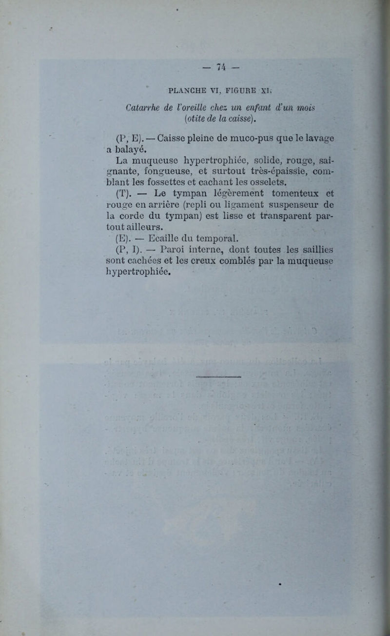 Catarrhe de l'oreille chez un enfant d'un mois (otite de la caisse). (P, E). — Caisse pleine de muco-pus que le lavage a balayé» La muqueuse hypertrophiée, solide, rouge, sai- gnante, fongueuse, et surtout très-épaissie, com- blant les fossettes et cachant les osselets. (T). — Le tympan légèrement tomenteux et rouge en arrière (repli ou ligament suspenseur de la corde du tympan) est lisse et transparent par- tout ailleurs. (E). — Ecaille du temporal. (P, I). — Paroi interne,, dont toutes les saillies sont cachées et les creux comblés par la muqueuse hypertrophiée.