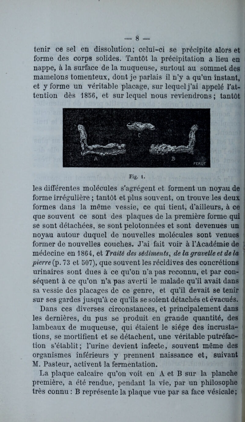 tenir ce sel en dissolution; celui-ci se précipite alors et forme des corps solides. Tantôt la précipitation a lieu en nappe, à la surface de la muqueuse, surtout au sommet des mamelons tomenteux, dont je parlais il n’y a qu’un instant, et y forme un véritable placage, sur lequel j’ai appelé l’at- tention dès 1856, et sur lequel nous reviendrons; tantôt Fig. i. les différentes molécules s’agrègent et forment un noyau de forme irrégulière ; tantôt et plus souvent, on trouve les deux formes dans la même vessie, ce qui tient, d’ailleurs, à ce que souvent ce sont des plaques de la première forme qui se sont détachées, se sont pelotonnées et sont devenues un noyau autour duquel de nouvelles molécules sont venues former de nouvelles couches. J’ai fait voir à l’Académie de médecine en 1864, et Traité des sédiments, de la gravelle et de la pierre (p. 73 et 507), que souvent les récidives des concrétions urinaires sont dues à ce qu’on n’a pas reconnu, et par con- séquent à ce qu’on n’a pas averti le malade qu’il avait dans sa vessie des placages de ce genre, et qu’il devait se tenir sur ses gardes jusqu’à ce qu’ils se soient détachés et évacués. Dans ces diverses circonstances, et principalement dans les dernières, du pus se produit en grande quantité, des lambeaux de muqueuse, qui étaient le siège des incrusta- tions, se mortifient et se détachent, une véritable putréfac- tion s’établit; l’urine devient infecte, souvent même des organismes inférieurs y prennent naissance et, suivant M. Pasteur, activent la fermentation. La plaque calcaire qu’on voit en A et B sur la planche première, a été rendue, pendant la vie, par un philosophe très connu : B représente la plaque vue par sa face vésicale;