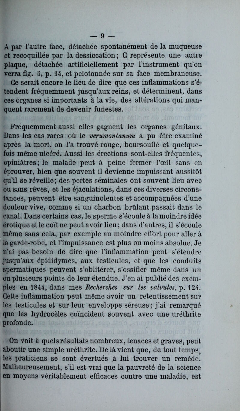 A par l’autre face, détachée spontanément de la muqueuse et recoquillée par la dessiccation; G représente une autre plaque, détachée artificiellement par l’instrument qu’on verra fig. 5, p. 34, et pelotonnée sur sa face membraneuse. Ce serait encore le lieu de dire que ces inflammations s’é- tendent fréquemment jusqu’aux reins, et déterminent, dans ces organes si importants à la vie, des altérations qui man- quent rarement de devenir funestes. Fréquemment aussi elles gagnent les organes génitaux. Dans les cas rares où le verumontanum a pu être examiné après la mort, on l’a trouvé rouge, boursouflé et quelque- fois même ulcéré. Aussi les érections sont-elles fréquentes, opiniâtres; le malade peut à peine fermer l’œil sans en éprouver, bien que souvent il devienne impuissant aussitôt qu’il se réveille ; des pertes séminales ont souvent lieu avec ou sans rêves, et les éjaculations, dans ces diverses circons- tances, peuvent être sanguinolentes et accompagnées d’une douleur vive, comme si un charbon brûlant passait dans le canal. Dans certains cas, le sperme s’écoule à la moindre idée érotique et le coït ne peut avoir lieu; dans d’autres, il s’écoule même sans cela, par exemple au moindre effort pour aller à la garde-robe, et l’impuissance est plus ou moins absolue. Je n’ai pas besoin de dire que l’inflammation peut s’étendre jusqu’aux épididymes, aux testicules, et que les conduits spermatiques peuvent s’oblitérer, s’ossifier même dans un ou plusieurs points de leur étendue. J’en ai publié des exem- ples en 1844, dans mes Recherches sur les valvules, p. 124. Cette inflammation peut même avoir un retentissement sur les testicules et sur leur enveloppe séreuse; j’ai remarqué que les hydrocèles coïncident souvent avec une uréthrite profonde. On voit à quels résultats nombreux, tenaces et graves, peut aboutir une simple uréthrite. Delà vient que, de tout temps, les praticiens se sont évertués à lui trouver un remède. Malheureusement, s’il est vrai que la pauvreté de la science en moyens véritablement efficaces contre une maladie, est