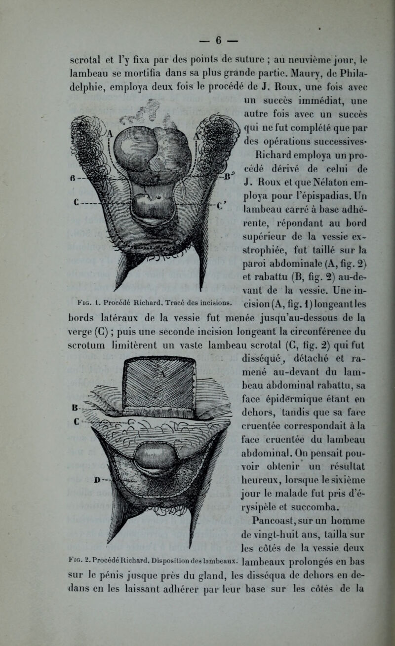 scrotal et l’y fixa par des points de suture ; au neuvième jour, le lambeau se mortifia dans sa plus grande partie. Maury, de Phila- delphie, employa deux fois le procédé de J, Roux, une fois avec un succès immédiat, une autre fois avec un succès qui ne fut complété que par des opérations successives* Richard employa un pro- cédé dérivé de celui de J. Roux et que Nélaton em- ploya pour l’épispadias. Un lambeau carré à base adhé- rente, répondant au bord supérieur de la vessie ex- strophiée, fut taillé sur la paroi abdominale (A, fig. 2) et rabattu (R, fig. 2) au-de- vant de la vessie. Une in- Fig. 1. Procédé Richard. Tracé des incisions. Cision (A, fig. 1) longeant les bords latéraux de la vessie fut menée jusqu’au-dessous de la verge (G) ; puis une seconde incision longeant la circonférence du scrotum limitèrent un vaste lambeau scrotal (G, fig. 2) qui fut disséqué, détaché et ra- mené au-devant du lam- beau abdominal rabattu, sa face épidermique étant en dehors, tandis que sa face cruentée correspondait à la face cruentée du lambeau abdominal. On pensait pou- voir obtenir un résultat heureux, lorsque le sixième jour le malade fut pris d’é- rysipèle et succomba. Pancoast,sur un homme de vingt-huit ans, tailla sur les côtés de la vessie deux Fig. 2. Procédé Richard. Disposition des lambeaux, lambeaux prolongés en bas sur le pénis jusque près du gland, les disséqua de dehors en de- dans en les laissant adhérer par leur base sur les côtés de la