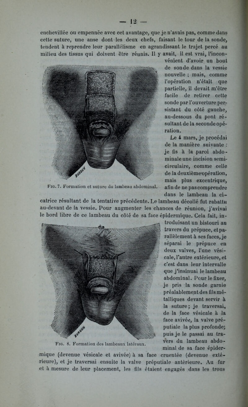 enchevillée ou empennée avec cet avantage, que je n’avais pas, comme dans cette suture, une anse dont les deux chefs, faisant le tour de la sonde, tendent à reprendre leur parallélisme en agrandissant le trajet percé au milieu des tissus qui doivent être réunis. Il y avait, il est vrai, l’incon- vénient d’avoir un bout de sonde dans la vessie nouvelle ; mais, comme l’opération n’était que partielle, il devait m’être facile de retirer cette sonde par l’ouverture per- sistant du côté gauche, au-dessous du pont ré- sultant de la seconde opé- ration. Le l mars, je procédai de la manière suivante : je fis à la paroi abdo- minale une incision semi- circulaire, comme celle de la deuxièmeopération, mais plus excentrique, Fig. 7. Formation et suture du lambeau abdominal. afin de ne pas comprendre dans le lambeau la ci- catrice résultant de la tentative précédente. Le lambeau décollé fut rabattu au-devant de la vessie. Pour augmenter les chances de réunion, j’avivai le bord libre de ce lambeau du côté de sa face épidermique. Cela fait, in- troduisant un bistouri au travers du prépuce, et pa- rallèlement à ses faces, je séparai le prépuce en deux valves, l’une vési- cale, l’autre extérieure, et c’est dans leur intervalle que j’insinuai le lambeau abdominal. Pour le fixer, je pris la sonde garnie préalablement des fils mé- talliques devant servir h la suture; je traversai, de la face vésicale à la face avivée, la valve pré- putiale la plus profonde; puis je le passai au tra- vers du lambeau abdo- minal de sa face épider- mique (devenue vésicale et avivée) à sa face cruentée (devenue exté- rieure), et je traversai ensuite la valve préputiale antérieure. Au fur et à mesure de leur placement, les fils étaient engagés dans les trous