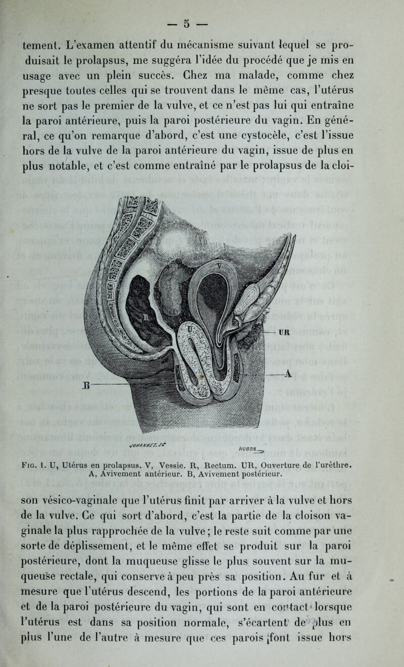 tement. L’examen attentif du mécanisme suivant lequel se pro- duisait le prolapsus, me suggéra l’idée du procédé que je mis en usage avec un plein succès. Chez ma malade, comme chez presque toutes celles qui se trouvent dans le même cas, l’utérus ne sort pas le premier de la vulve, et ce n’est pas lui qui entraîne la paroi antérieure, puis la paroi postérieure du vagin. En géné- ral, ce qu’on remarque d’abord, c’est une cystocèle, c’est l’issue hors de la vulve de la paroi antérieure du vagin, issue de plus en plus notable, et c’est comme entraîné par le prolapsus de la cloi- son vésico-vaginale que l’utérus finit par arriver à la vulve et hors de la vulve. Ce qui sort d’abord, c’est la partie de la cloison va- ginale la plus rapprochée de la vulve ; le reste suit comme par une sorte de déplissement, et le même effet se produit sur la paroi postérieure, dont la muqueuse glisse le plus souvent sur la mu- queuse rectale, qui conserve à peu près sa position. Au fur et à mesure que l’utérus descend, les portions de la paroi antérieure et de la paroi postérieure du vagin, qui sont en contact*lorsque l’utérus est dans sa position normale, s’écartent de plus en plus l’une de l’autre à mesure que ces parois jfont issue hors Fig. 1. U, Utérus en prolapsus. V, Vessie. R, Rectum. UR, Ouverture de l’urèthre. A, Avivement antérieur. B, Avivement postérieur. soz/tA/ysr. s* HUGOH a