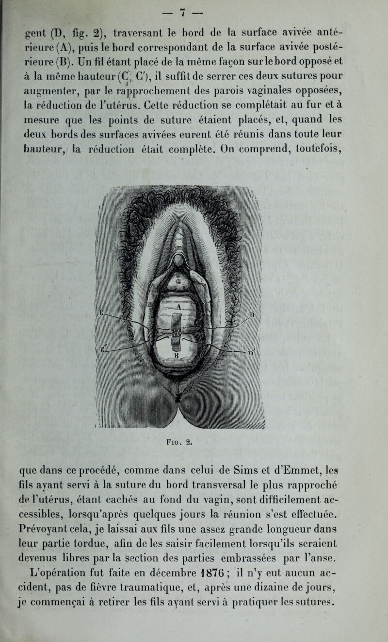 gent (D, fig. 2), traversant le bord de la surface avivée anté- rieure (A), puis le bord correspondant de la surface avivée posté- rieure (B). Un fil étant placé de la même façon sur le bord opposé et à la même hauteur (C, G'), il suffit de serrer ces deux sutures pour augmenter, par le rapprochement des parois vaginales opposées, la réduction de l’utérus. Cette réduction se complétait au fur et à mesure que les points de suture étaient placés, et, quand les deux bords des surfaces avivées eurent été réunis dans toute leur hauteur, la réduction était complète. On comprend, toutefois, Fig. 2. que dans ce procédé, comme dans celui de Sims et d’Emmet, les fils ayant servi à la suture du bord transversal le plus rapproché de l’utérus, étant cachés au fond du vagin, sont difficilement ac- cessibles, lorsqu’après quelques jours la réunion s’est effectuée. Prévoyant cela, je laissai aux fils une assez grande longueur dans leur partie tordue, afin de les saisir facilement lorsqu’ils seraient devenus libres par la section des parties embrassées par l’anse. L’opération fut faite en décembre 1876; il n’y eut aucun ac- cident, pas de fièvre traumatique, et, après une dizaine de jours, je commençai à retirer les fils ayant servi à pratiquer les sutures.