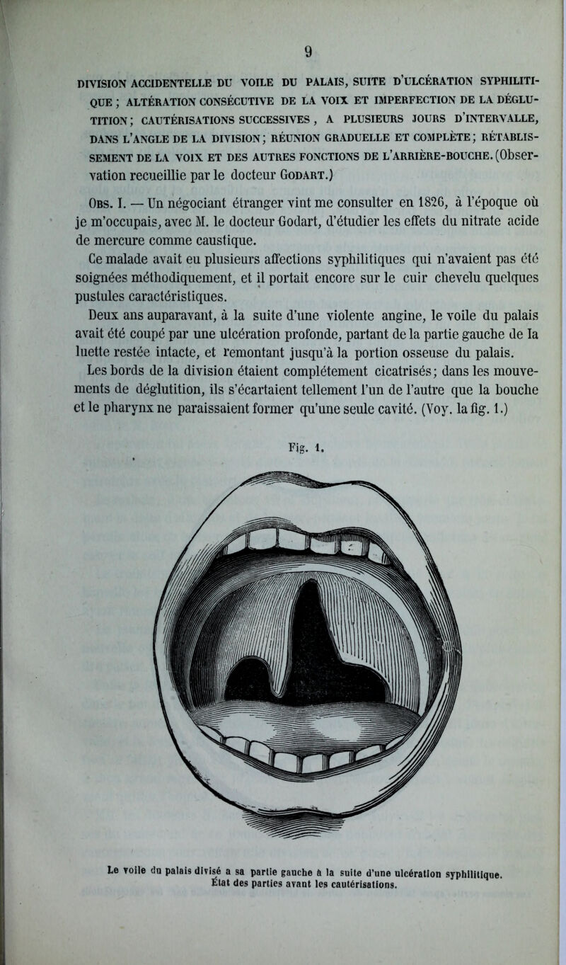 DIVISION ACCIDENTELLE DU VOILE DU PALAIS, SUITE D’ULCÉRATION SYPHILITI- QUE ; ALTÉRATION CONSÉCUTIVE DE LA VOIX ET IMPERFECTION DE LA DÉGLU- TITION ; CAUTÉRISATIONS SUCCESSIVES, A PLUSIEURS JOURS D’iNTERVALLE, DANS L’ANGLE DE LA DIVISION ; RÉUNION GRADUELLE ET COMPLÈTE ; RÉTABLIS- SEMENT de la voix et des autres fonctions de l’arrière-bouche. (Obser- vation recueillie par le docteur Godart.) Obs. I. — Un négociant étranger vint me consulter en 1826, à l’époque où je m’occupais, avec M. le docteur Godart, d’étudier les effets du nitrate acide de mercure comme caustique. Ce malade avait eu plusieurs affections syphilitiques qui n’avaient pas été soignées méthodiquement, et il portait encore sur le cuir chevelu quelques pustules caractéristiques. Deux ans auparavant, à la suite d’une violente angine, le voile du palais avait été coupé par une ulcération profonde, partant de la partie gauche de la luette restée intacte, et remontant jusqu’à la portion osseuse du palais. Les bords de la division étaient complètement cicatrisés; dans les mouve- ments de déglutition, ils s’écartaient tellement l’un de l’autre que la bouche et le pharynx ne paraissaient former qu’une seule cavité. (Voy. laflg. 1.) Fig. i. Le voile du palais divisé a sa partie gauche a la suite d’une ulcération syphilitique. Etat des parties avant les cautérisations.