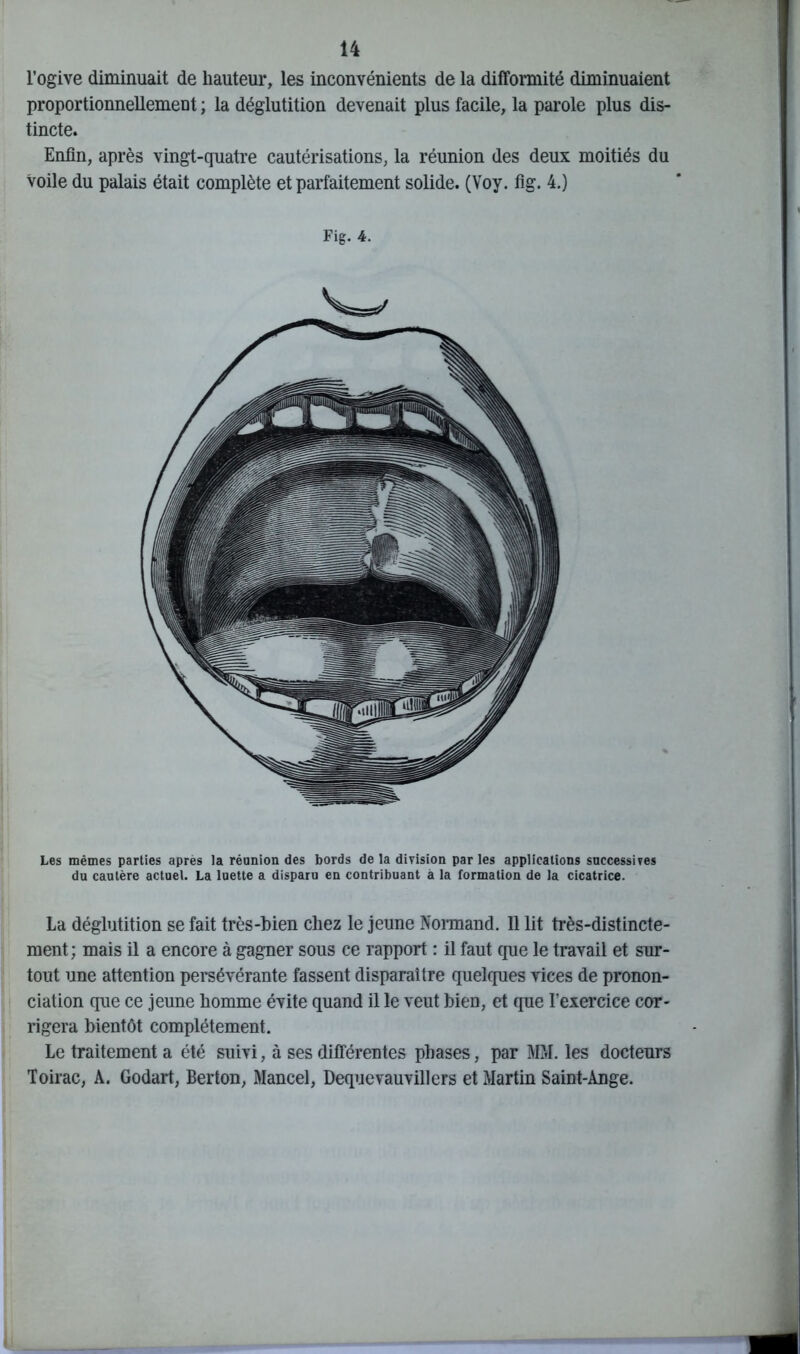 l’ogive diminuait de hauteur, les inconvénients de la difformité diminuaient proportionnellement ; la déglutition devenait plus facile, la parole plus dis- tincte. Enfin, après vingt-quatre cautérisations, la réunion des deux moitiés du voile du palais était complète et parfaitement solide. (Voy. fig. 4.) Fig. 4. Les mêmes parties apres la réunion des bords de la division parles applications successives du cautère actuel. La luette a disparu en contribuant à la formation de la cicatrice. La déglutition se fait très-bien chez le jeune Normand. Il lit très-distincte- ment; mais il a encore à gagner sous ce rapport : il faut que le travail et sur- tout une attention persévérante fassent disparaître quelques vices de pronon- ciation que ce jeune homme évite quand il le veut bien, et que l’exercice cor- rigera bientôt complètement. Le traitement a été suivi, à ses différentes phases, par MM. les docteurs Toirac, A. Godart, Berton, Mancel, Dequevauvillers et Martin Saint-Ange.