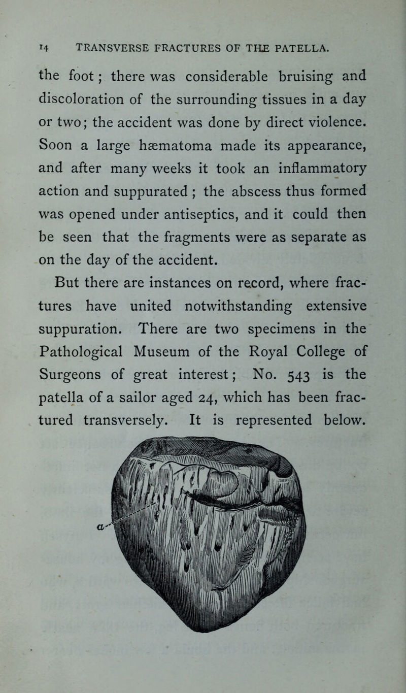 the foot; there was considerable bruising and discoloration of the surrounding tissues in a day or two; the accident was done by direct violence. Soon a large haematoma made its appearance, and after many weeks it took an inflammatory action and suppurated ; the abscess thus formed was opened under antiseptics, and it could then be seen that the fragments were as separate as on the day of the accident. But there are instances on record, where frac- tures have united notwithstanding extensive suppuration. There are two specimens in the Pathological Museum of the Royal College of Surgeons of great interest; No. 543 is the patella of a sailor aged 24, which has been frac- tured transversely. It is represented below.