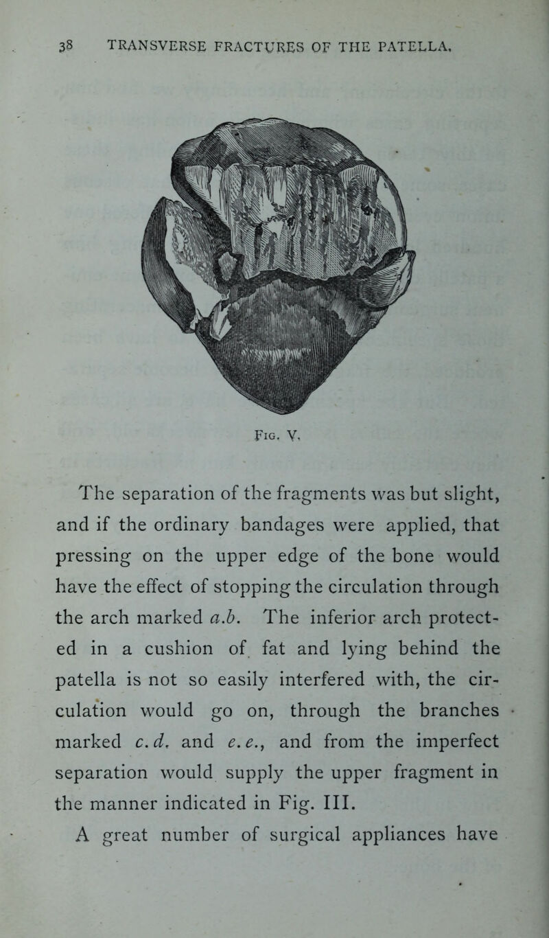 Fig. V, The separation of the fragments was but slight, and if the ordinary bandages were applied, that pressing on the upper edge of the bone would have the effect of stopping the circulation through the arch marked a.b. The inferior arch protect- ed in a cushion of fat and lying behind the patella is not so easily interfered with, the cir- culation would go on, through the branches marked c.d, and e. e., and from the imperfect separation would supply the upper fragment in the manner indicated in Fig. III. A great number of surgical appliances have