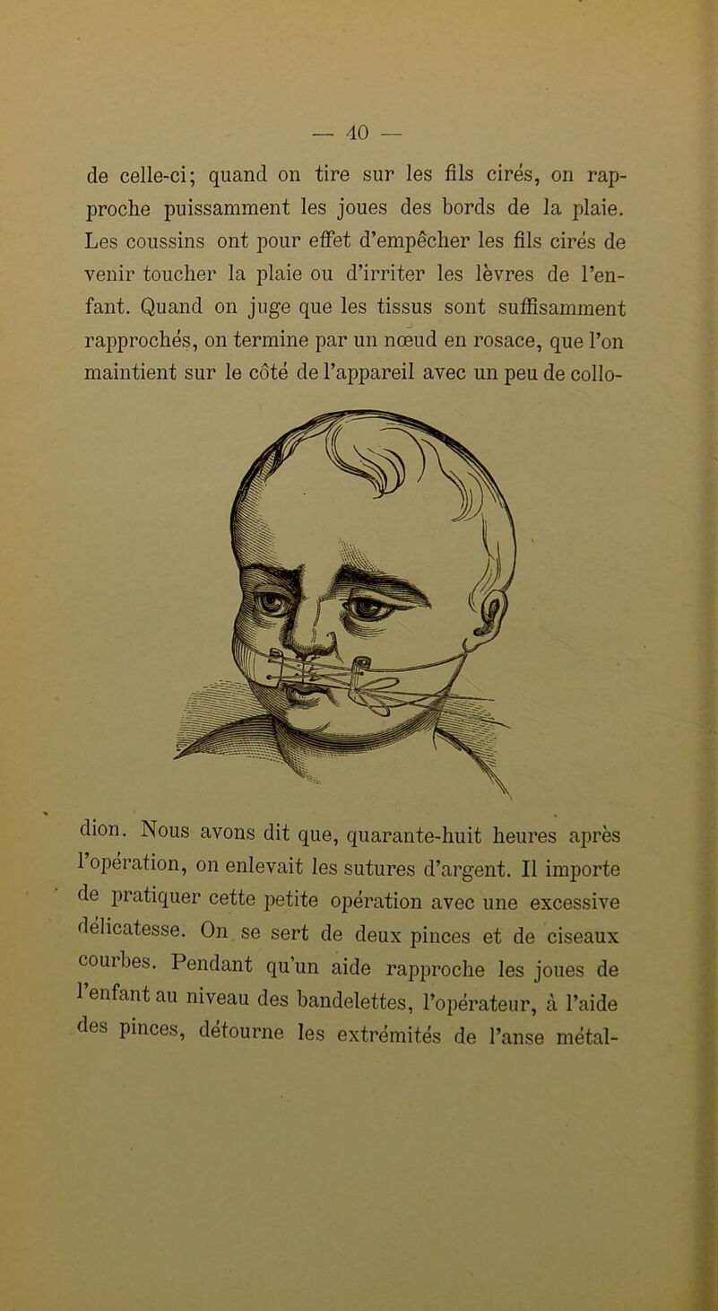 de celle-ci; quand on tire sur les fils cirés, on rap- proche puissamment les joues des bords de la plaie. Les coussins ont pour effet d’empêcher les fils cirés de venir toucher la plaie ou d’irriter les lèvres de l’en- fant. Quand on juge que les tissus sont suffisamment rapprochés, on termine par un nœud en rosace, que l’on maintient sur le côté de l’appareil avec un peu de collo- dion. Nous avons dit que, quarante-huit heures après 1 operation, on enlevait les sutures d’argent. Il importe de pratiquer cette petite opération avec une excessive délicatesse. On se sert de deux pinces et de ciseaux courbes. Pendant qu’un aide rapproche les joues de 1 enfant au niveau des bandelettes, l’opérateur, à l’aide des pinces, détourne les extrémités de l’anse métal-