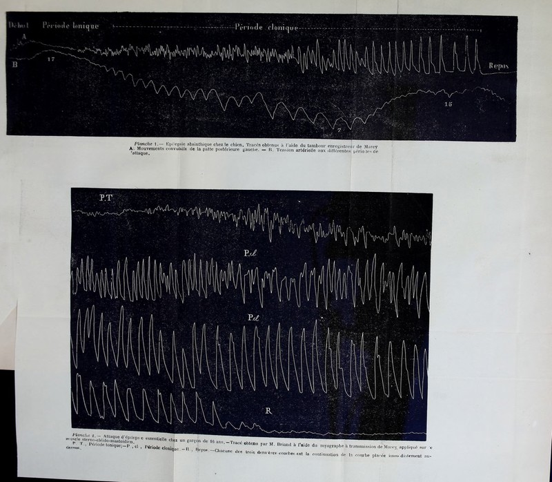 Planche 1.- Epilepsie absinthique chez le chien. Tracés obtenus à l’aide du tambour enregistreur de Marev A. Mouvements convulsifs de la patte postérieure gauche. — B. Tension artérielle aux différentes uério les rie 3lt3QU6, H ''lu^le^sterao-cléido-rnastoi^en?^8 * csseidielle chez un garçon de 16 ans.—Tracé «ht . . si: dès-in. ’ Pénodfi tonique;-P ,'C1 , Période clonîjue -R r CDU Par M- Bnand a 1,aide du myographe à transmission de Marey. appliqué sur e ’ P°P * U°iS awn'èrcs courb6s««t ta continuation de la courbe placée immédiatement au-