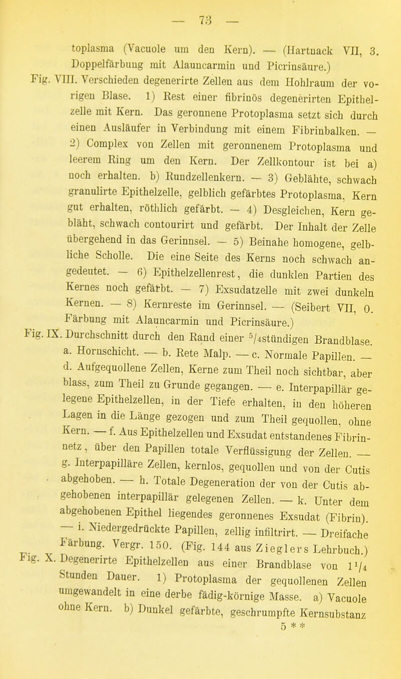 toplasma (Vacuole um den Kern). — (Hartnack VII, 3. Doppelfärbung mit Alauucarmin und Picriusäure.) Fig. VIII. Verschieden degenerirte Zellen aus dem Hohlraum der vo- rigen Blase. 1) Rest einer fibrinös degenerirten Epithel- zelle mit Kern. Das geronnene Protoplasma setzt sich durch einen Ausläufer in Verbindung mit einem Fibrinbalken. — 2) Complex von Zellen mit geronnenem Protoplasma und leerem Ring um den Kern. Der Zellkontour ist bei a) noch erhalten, b) Rundzellenkern. - 3) Geblähte, schwach granulirte Epithelzelle, gelblich gefärbtes Protoplasma. Kern gut erhalten, röthlich gefärbt. — 4) Desgleichen, Kern ge- bläht, schwach contourirt und gefärbt. Der Inhalt der Zelle über gehend in das Gerinnsel. — 5) Beinahe homogene, gelb- liche Scholle. Die eine Seite des Kerns noch schwach an- gedeutet. — 6) Epithelzellenrest, die dunklen Partien des Kernes noch gefärbt. — 7) Exsudatzelle mit zwei dunkeln Kernen. — 8) Kernreste im Gerinnsel. — (Seibert VII, 0. f ärbung mit Alauucarmin und Picrinsäure.) f ig. IX. Durchschnitt durch den Rand einer 5/4stündigen Brandblase. a. Hoinschicht. b. Rete Malp. —c. Normale Papillen. d. Aufgequollene Zellen, Kerne zum Theil noch sichtbar, aber blass, zum Theil zu Grunde gegangen. — e. Interpapillär ge- legene Epithelzellen, in der Tiefe erhalten, in den höheren Lagen in die Länge gezogen und zum Theil gequollen, ohne Kern. i. Aus Epithelzellen und Exsudat entstandenes Fibrin- netz , über den Papillen totale Verflüssigung der Zellen. — g. Interpapilläre Zellen, kernlos, gequollen und von der Cutis abgehoben. — h. Totale Degeneration der von der Cutis ab- gehobenen interpapillär gelegenen Zellen. — k. Unter dem abgehobenen Epithel liegendes geronnenes Exsudat (Fibrin). i. Niedergedrückte Papillen, zellig infiltrirt. — Dreifache Iärbung. Vergr. 150. (Fig. 144 aus Zieglers Lehrbuch ) f ig. X. Degenerirte Epithelzellen aus einer Brandblase von U/4 Stunden Dauer, l) Protoplasma der gequollenen Zellen umgewandelt in eine derbe fädig-körnige Masse, a) Vacuole ohne Kern, b) Dunkel gefärbte, geschrumpfte Kernsubstanz 5**