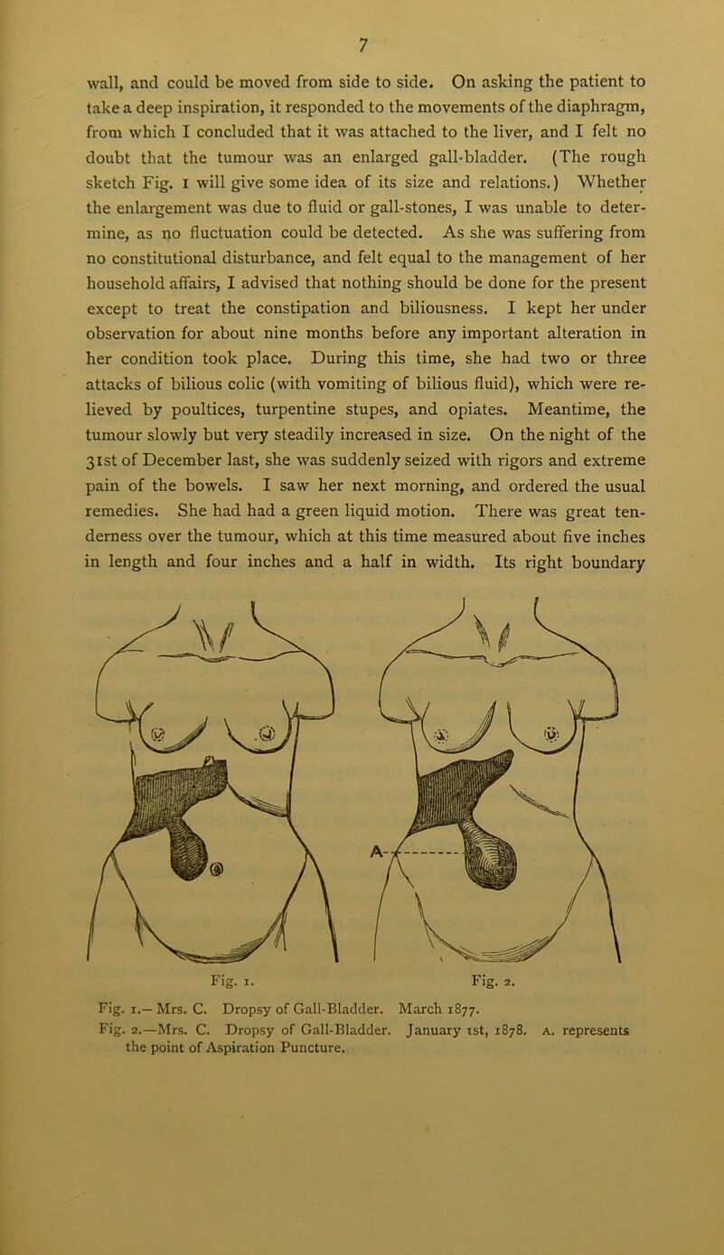 wall, and could be moved from side to side. On asking the patient to take a deep inspiration, it responded to the movements of the diaphragm, from which I concluded that it was attached to the liver, and I felt no doubt that the tumour was an enlarged gall-bladder. (The rough sketch Fig. I will give some idea of its size and relations.) Whether the enlargement was due to fluid or gall-stones, I was unable to deter- mine, as 1)0 fluctuation could be detected. As she was suffering from no constitutional disturbance, and felt equal to the management of her household affairs, I advised that nothing should be done for the present except to treat the constipation and biliousness. I kept her under observation for about nine months before any important alteration in her condition took place. During this time, she had two or three attacks of bilious colic (with vomiting of bilious fluid), which were re- lieved by poultices, turpentine stupes, and opiates. Meantime, the tumour slowly but very steadily increased in size. On the night of the 31st of December last, she was suddenly seized with rigors and extreme pain of the bowels. I saw her next morning, and ordered the usual remedies. She had had a green liquid motion. There was great ten- derness over the tumour, which at this time measured about five inches in length and four inches and a half in width. Its right boundary Fig. I. Fig. 2. Fig. X.— Mrs. C. Dropsy of Gall-Bladder. March 1877. Fig. 2.—Mrs. C. Dropsy of Gall-Bladder. January ist, 1878. a. represents the point of Aspiration Puncture.