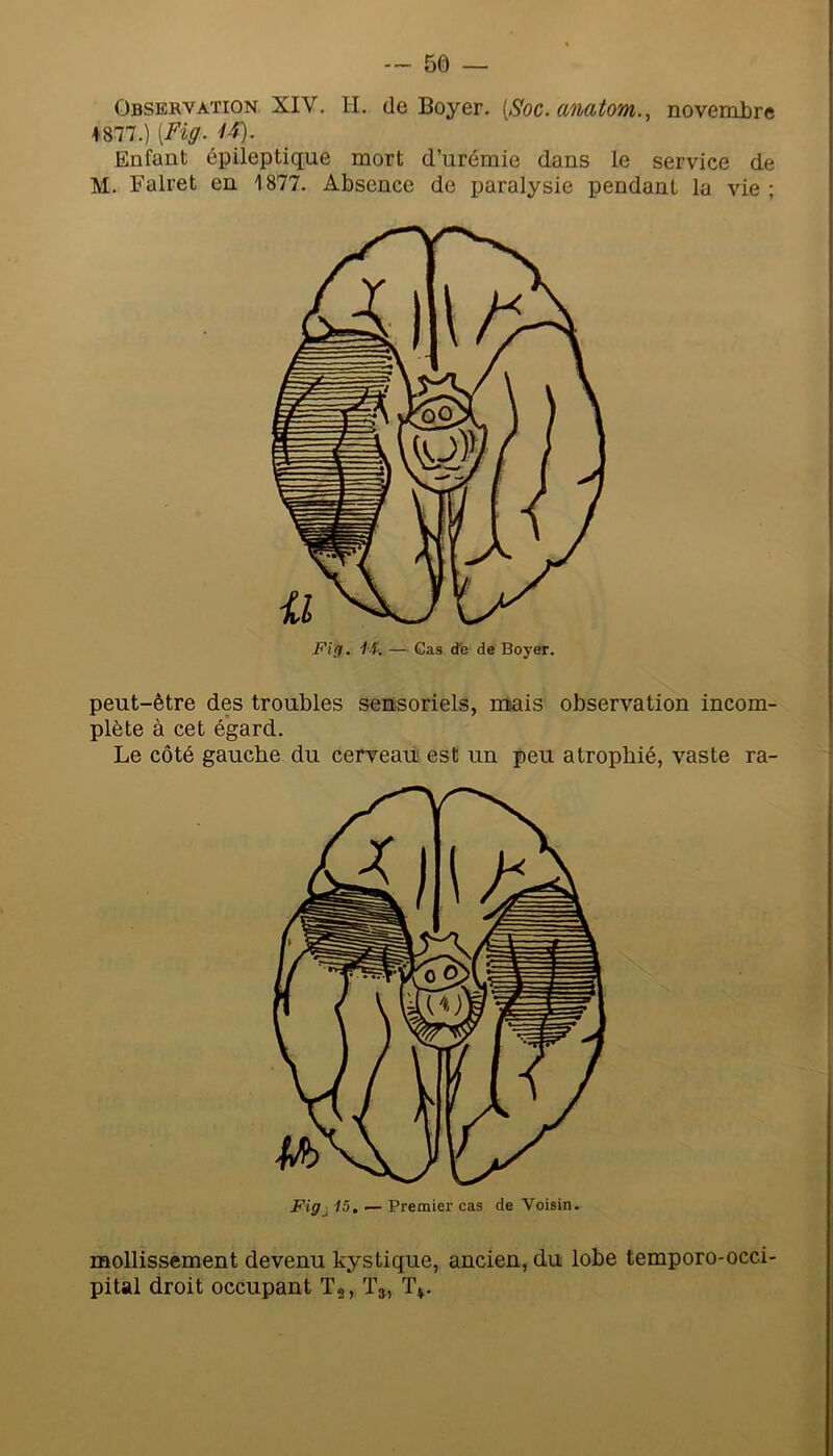 Observation XIV. IL de Boyer. [Soc. amtom., novembre ♦877.) [Fig. U). Enfant épileptique mort d’urémie dans le service de M. Falret en 1877. Absence de paralysie pendant la vie ; Fi/f. if. — Cas d'e de Boyer. peut-être des troubles sensoriels, mais observation incom- plète à cet égard. Le côté gauche du cerveau est un peu atrophié, vaste ra- Figj 15, Premier cas de Voisin. mollissement devenu kystique, ancien, du lobe temporo-occi- pital droit occupant Tg, Tg, T^.