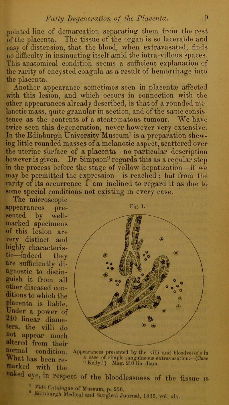 pointed line of demarcation separating them from the rest of the placenta. The tissue of the organ is so lacerable and easy of distension, that the blood, when extravasated, finds no difficulty in insinuating itself amid the intra-villous spaces. This anatomical condition seems a sufficient explanation of the rarity of encysted coagula as a result of hemorrhage into the placenta. Another appearance sometimes seen in placentae affected with this lesion, and which occurs in connection with the other appearances already described, is that of a rounded me- lanotic mass, quite granular in section, and of the same consis- tence as the contents of a steatomatous tumour. We have twice seen this degeneration, never however very extensive. In the Edinburgh University Museum1 is a preparation shew- ing little rounded masses of a melanotic aspect, scattered over the uterine surface of a placenta—no particular description however is given. Dr Simpson2 regards this as a regular step in the process before the stage of yellow hepatization—if we may be permitted the expression—is reached ; but from the rarity of its occurrence I am inclined to regard it as due to some special conditions not existing in every case. The microscopic appearances pre- sented by well- marked specimens of this lesion are very distinct and highly characteris- tic—indeed they are sufficiently di- agnostic to distin- guish it from all other diseased con- ditions to which the placenta is liable. Under a power of 240 linear diame- ters, the villi do not appear much altered from their normal condition. What has been re- marked with the Fig. 1. Appearances presented by the villi and bloodvessels in a case of simple sanguineous extravasation.—(Case “ Kelly.”) Mag. 210 lin. diam. naked eye, in respect of the bloodlessness of the tissue is ’ Vide Catalogue of Museum, p. 256. Edinburgh Medical and Surgical Journal, 1836. vol. xlv.