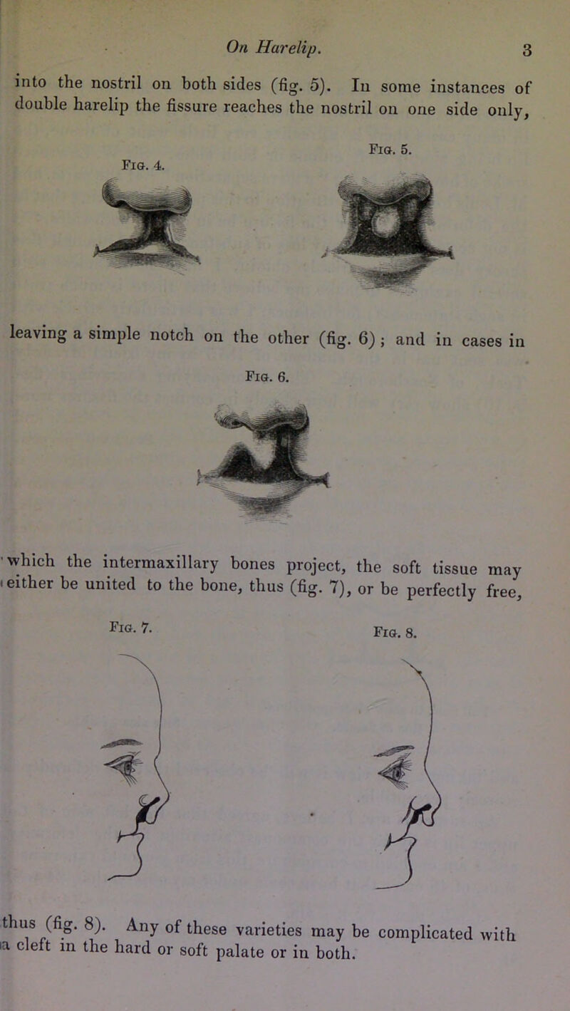 into the nostril on both sides (fig. 5). In some instances of double harelip the fissure reaches the nostril on one side only. Fig. 4. Fig. 5. leaving a simple notch on the other (fig. 6) ; and in cases in Fig. 6. which the intermaxillary bones project, the soft tissue may i either be united to the bone, thus (fig. 7), or be perfectly free. Fl°■ 7- Fig. 8. thus (fig. 8). Any of these varieties may be complicated with