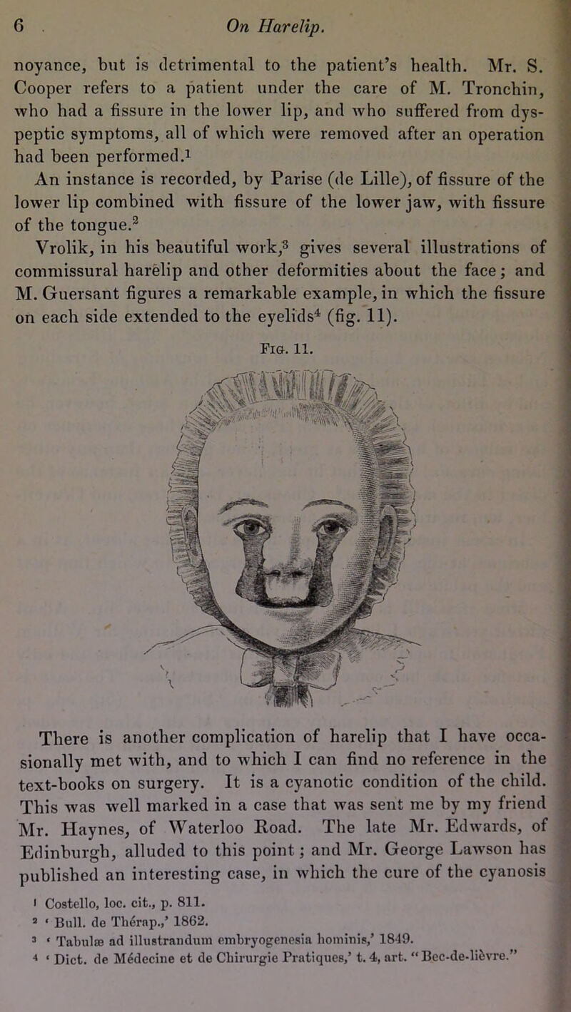 noyance, but is detrimental to the patient’s health. Mr. S. Cooper refers to a patient under the care of M. Tronchin, who had a fissure in the lower lip, and who suffered from dys- peptic symptoms, all of which were removed after an operation had been performed.1 An instance is recorded, by Parise (de Lille), of fissure of the lower lip combined with fissure of the lower jaw, with fissure of the tongue.3 Vrolik, in his beautiful work,3 gives several illustrations of commissural harelip and other deformities about the face; and M. Guersant figures a remarkable example, in which the fissure on each side extended to the eyelids4 (fig. 11). Fig. 11. There is another complication of harelip that I have occa- sionally met with, and to which I can find no reference in the text-books on surgery. It is a cyanotic condition of the child. This was well marked in a case that was sent me by my friend Mr. Haynes, of Waterloo Road. The late Mr. Edwards, of Edinburgh, alluded to this point; and Mr. George Lawson has published an interesting case, in which the cure of the cyanosis 1 Costello, loc. cit., p. 811. 2 ‘ Bull, de Thernp.,’ 1862. 3 * Tabula ad illustrandum embryogenesia hominis/ 1849. 4 ‘ Diet, de M^decine et de Chirurgie Pratiques,’ t. 4, art. “Bec-de-liiivrc.”