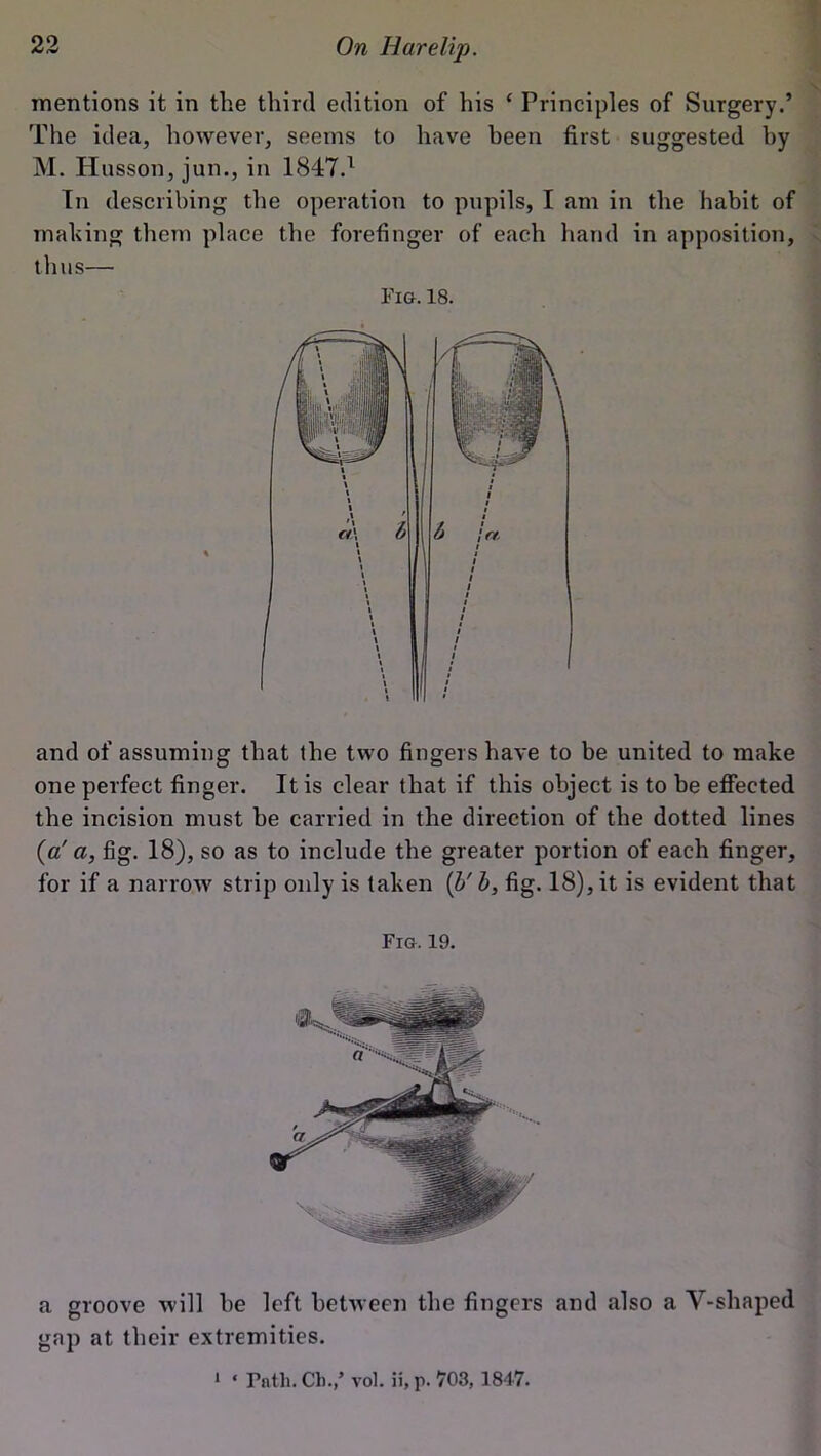 mentions it in the third edition of his ‘ Principles of Surgery.’ The idea, however, seems to have been first suggested by M. Hasson, jun., in 1847.1 In describing the operation to pupils, I am in the habit of making them place the forefinger of each hand in apposition, thus— Fig. 18. and of assuming that the two fingers have to be united to make one perfect finger. It is clear that if this object is to be effected the incision must be carried in the direction of the dotted lines (a' a, fig. 18), so as to include the greater portion of each finger, for if a narrow strip only is taken (l>' b, fig. 18), it is evident that Fig. 19. a groove will be left between the fingers and also a Y-shaped gap at their extremities. * « Fnth. Cl)./ vol. ii, p. 703, 1847.