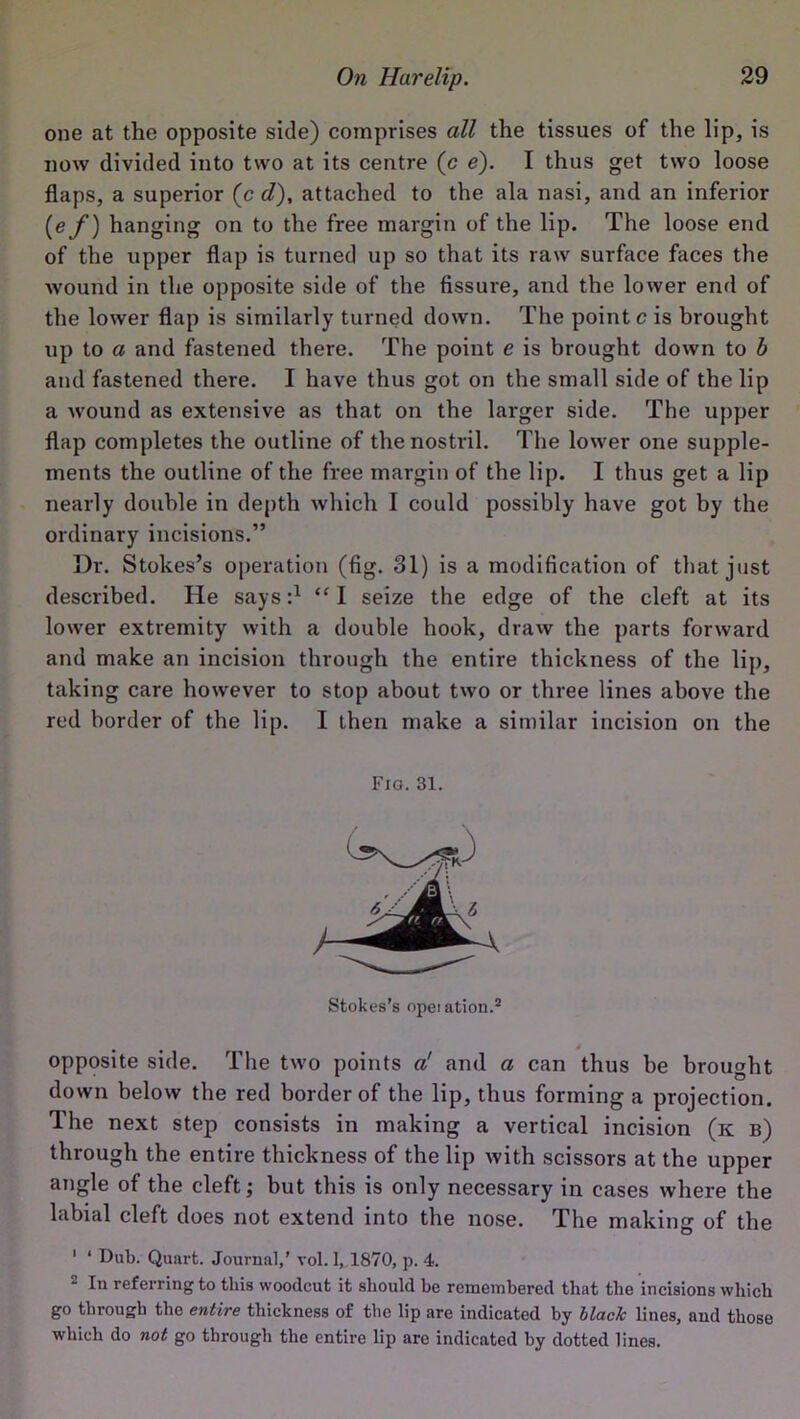 one at the opposite side) comprises all the tissues of the lip, is now divided into two at its centre (c e). I thus get two loose flaps, a superior (c d), attached to the ala nasi, and an inferior (e f) hanging on to the free margin of the lip. The loose end of the upper flap is turned up so that its raw surface faces the wound in the opposite side of the fissure, and the lower end of the lower flap is similarly turned down. The point c is brought up to a and fastened there. The point e is brought down to b and fastened there. I have thus got on the small side of the lip a wound as extensive as that on the larger side. The upper flap completes the outline of the nostril. The lower one supple- ments the outline of the free margin of the lip. I thus get a lip nearly double in depth which I could possibly have got by the ordinary incisions.” Dr. Stokes’s operation (fig. 31) is a modification of that just described. He says:1 “ I seize the edge of the cleft at its lower extremity with a double hook, draw the parts forward and make an incision through the entire thickness of the lip, taking care however to stop about two or three lines above the red border of the lip. I then make a similar incision on the Fig. 31. Stokes’s opetation.2 opposite side. The two points a' and a can thus be brought down below the red border of the lip, thus forming a projection. The next step consists in making a vertical incision (k b) through the entire thickness of the lip with scissors at the upper angle of the cleft; but this is only necessary in cases where the labial cleft does not extend into the nose. The making of the 1 ‘ Dub. Quart. Journal,’ vol. 1, 1870, p. 4. 2 In referring to this woodcut it should he remembered that the incisions which go through the entire thickness of the lip are indicated by black lines, and those which do not go through the entire lip are indicated by dotted lines.