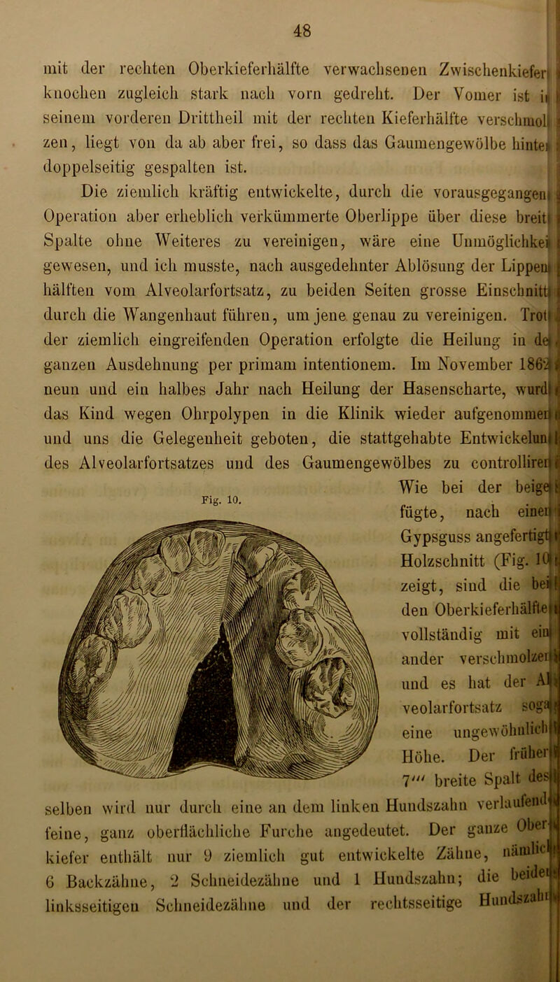 mit der rechten Oberkieferhälfte verwachsenen Zwischenkiefen j knocken zugleich stark nach vorn gedreht. Der Vomer ist i» jj seinem vorderen Drittheil mit der rechten Kieferhälfte versclnuol): j zen, liegt von da ab aber frei, so dass das Gaumengewölbe hinten \ doppelseitig gespalten ist. Die ziemlich kräftig entwickelte, durch die vorausgegangeni 3 Operation aber erheblich verkümmerte Oberlippe über diese breit« i Spalte ohne Weiteres zu vereinigen, wäre eine Unmöglichkeit I gewesen, und ich musste, nach ausgedehnter Ablösung der Lippen» j hälften vom Alveolarfortsatz, zu beiden Seiten grosse Einschnitt» j durch die Wangenhaut führen, um jene genau zu vereinigen. TrotiJ der ziemlich eingreifenden Operation erfolgte die Heilung in de»J ganzen Ausdehnung per primam intentionem. Im November 186*34 neun und ein halbes Jahr nach Heilung der Hasenscharte, wurd\t das Kind wegen Ohrpolypen in die Klinik wieder aufgenommer» d und uns die Gelegenheit geboten, die stattgehabte Entwickeluni f des Alveolarfortsatzes und des Gaumengewölbes zu controllirerfl Wie bei der beige» i\ fügte, nach einen j Gypsguss angefertigtfij Holzschnitt (Fig. 10t zeigt, sind die bei» den Oberkieferhälftet vollständig mit eint ander verschmolzen und es hat der Al veolarfortsatz sog! eine ungewöhnlich Höhe. Der früher 7' breite Spalt des 1 selben wird nur durch eine an dem linken Hundszahn verlaufend Fig. 10. 4 feine, ganz oberflächliche Furche angedeutet. Der ganze Ober kiefer enthält nur Ü ziemlich gut entwickelte Zähne, nämhc j G Backzähne, 2 Schneidezähne und 1 Hundszahn; die beule»ü linksseitigen Schneidezähne und der rechtsseitige HundsM 11