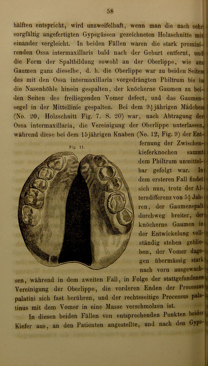 hälften entspricht, wird unzweifelhaft, wenn man die nach sehr, i sorgfältig angefertigten Gypsgüssen gezeichneten Holzschnitte mit» j einander vergleicht. In beiden Fällen waren die stark promini-fcj renden Ossa intermaxillaris bald nach der Geburt entfernt, und j) die Form der Spaltbildung sowohl an der Oberlippe, wie am* Gaumen ganz dieselbe, d. h. die Oberlippe war zu beiden Seiten i des mit den Ossa intermaxillaria vorgedrängten Philtrum bis iw i die Nasenhöhle hinein gespalten, der knöcherne Gaumen zu bei- 1 den Seiten des freiliegenden Yomer defect, und das Gaumen-* ] segel in der Mittellinie gespalten. Bei dem 9^jährigen Mädchen» I (No. 20, Holzschnitt Fig. 7. S. 20) war, nach Abtragung den j Ossa intermaxillaria, die Vereinigung der Oberlippe unterlassen^! während diese bei dem 15jährigen Knaben (No. 12, Fig. 9) der Ent- j fernung der Zwischen-^ Fig. 11. ° kieferknochen sammt) I dem Philtrum unmittel- 1 bar gefolgt war. Int dem ersteren Fall findet Ik sich nun, trotz der A1--. tersdifferenzvon 5^- Jah- ren, der Gaumenspaltj, durchweg breiter, den, knöcherne Gaumen in | der Entwickelung voll- * f ständig stehen geblie-*, ben, der Vomer dage->t' gen übermässig starkir nach vorn ausgewach-n sen, während in dem zweiten Fall, in Folge der stattgefundenen), Vereinigung der Oberlippe, die vorderen Enden der Processus jj palatini sich fast berühren, und der rechtsseitige Processus pala-l^ tinus mit dem Vomer in eine Masse verschmolzen ist. In diesen beiden Fällen von entsprechenden Punkten beide» j, Kiefer aus, an den Patienten angestellte, und nach den Gyp*'^