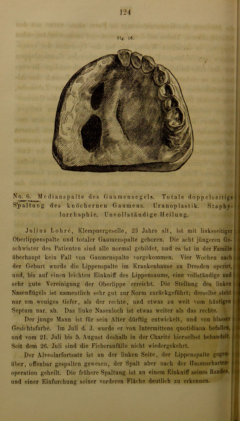 Fi*. 16. No. 6. Medianspalte des Gaumensegels. Totale doppelseitige! S'paltung des knöchernen Gaumens. Uranoplast ik. Staphy- lorrhaphie. Unvollständige Heilung. Julius Lohre, Klempnergeselle, 23 Jahre alt, ist mit linksseitiger! Oberlippenspalte und totaler Gaumenspalte geboren. Die acht jüngeren Ge- schwister des Patienten sind alle normal gebildet, und es ist in der Familie > überhaupt kein Fall vou Gaumenspalte vorgekommen. Vier Wochen nach i der Geburt wurde die Lippenspalte im Krankenhause zu Dresden operirt, j| und, bis auf einen leichten Einkniff des Lippensaums, eine vollständige nnd i sehr gute Vereinigung der Oberlippe erreicht. Die Stellung des linken ( Nasenflügels ist namentlich sehr gut zur Norm zurückgeführt; derselbe steht ij nur um weniges tiefer, als der rechte, und etwas zu weit vom häutigen! Septum nar. ab. Das linke Nasenloch ist etwas weiter als das rechte. Der junge Mann ist für sein Alter dürftig entwickelt, und von blasser j Gesichtsfarbe. Im Juli d. J. wurde er von Intermittens quotidiana befallen, i und vom 21. Juli bis 5. August deshalb in der Charite hierselbst behandelt. Seit dem 26. Juli sind die Fieberanfälle nicht wiedergekehrt. Der Alveolarfortsatz ist an der linken Seite, der Lippenspalte gegen- über, offenbar gespalten gewesen, der Spalt aber nach der Hasenscharten- operation geheilt. Die frühere Spaltung ist an einem Einkniff seines Randes, und einer Einfurchung seiner vorderen Fläche deutlich zu erkennen.