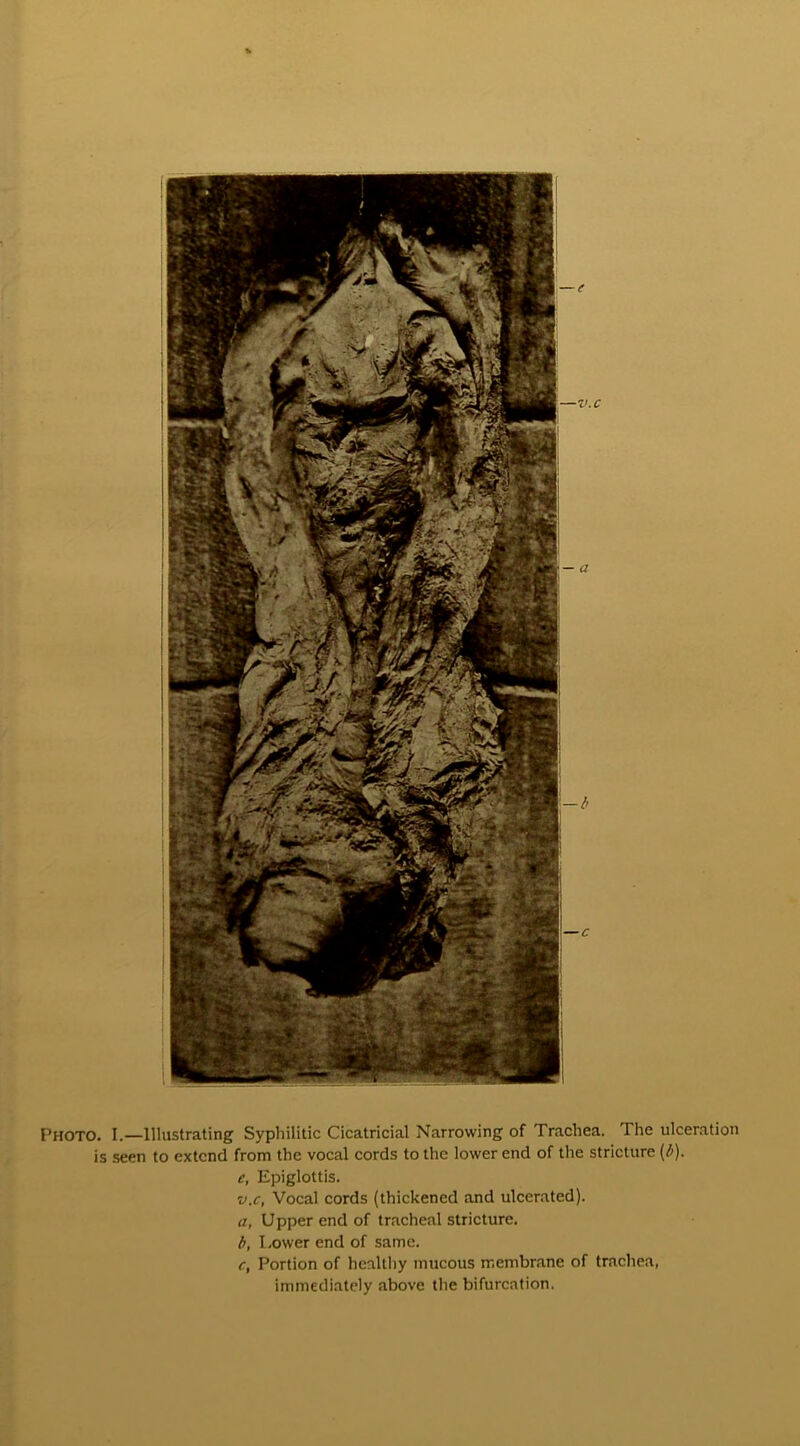 Photo. I.—lllustrating Syphilitic Cicatricial Narrowing of Trachea. The ulcération is seen to extcnd from tlie vocal cords to the lower end of the stricture (b), e, Epiglottis. v.c, Vocal cords (thickened and ulcerated). a, Upper end of trachéal stricture. b, Lower end of same. c, Portion of healthy mucous membrane of trachea, immediately above the bifurcation.