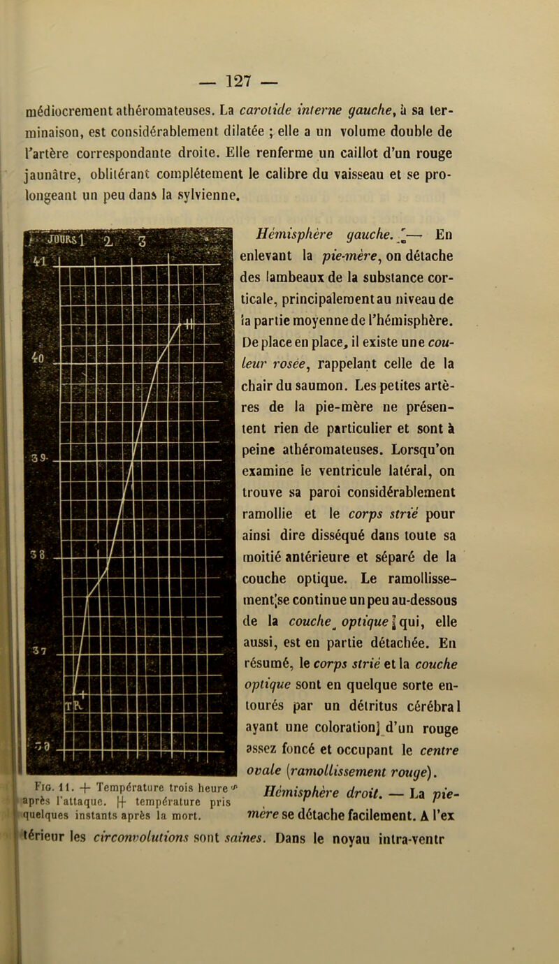 médiocrement athéromateuses. La carotide interne gauche, \ii sa ter- minaison, est considérablement dilatée ; elle a un volume double de l’artère correspondante droite. Elle renferme un caillot d’un rouge jaunâtre, oblitérant complètement le calibre du vaisseau et se pro- longeant un peu dans la sylvienne. Fio. 11. Température trois heure''* après l’attaque, [j- température pris j quelques instants après la mort. Hémisphère gauche. ^' En enlevant la pie-mère, on détache des lambeaux de la substance cor- ticale, principalement au niveau de la partie moyenne de l’hémisphère. De place en place, il existe une cou- leur rosée, rappelant celle de la chair du saumon. Les petites artè- res de la pie-mère ne présen- tent rien de particulier et sont à peine athéromateuses. Lorsqu’on examine le ventricule latéral, on trouve sa paroi considérablement ramollie et le corps strié pour ainsi dire disséqué dans toute sa moitié antérieure et séparé de la couche optique. Le ramollisse- ment|se continue un peu au-dessous de la couche^ optique I qui, elle aussi, est en partie détachée. En résumé, le corps strié et la couche optique sont en quelque sorte en- tourés par un détritus cérébral ayant une coloration] d’un rouge assez foncé et occupant le centre ovale [ramollissement rouge). Hémisphère droit. — La pie- mère se détache facilement. A l’ex t lérieur les circonvolutions sont saines. Dans le noyau intra-ventr i