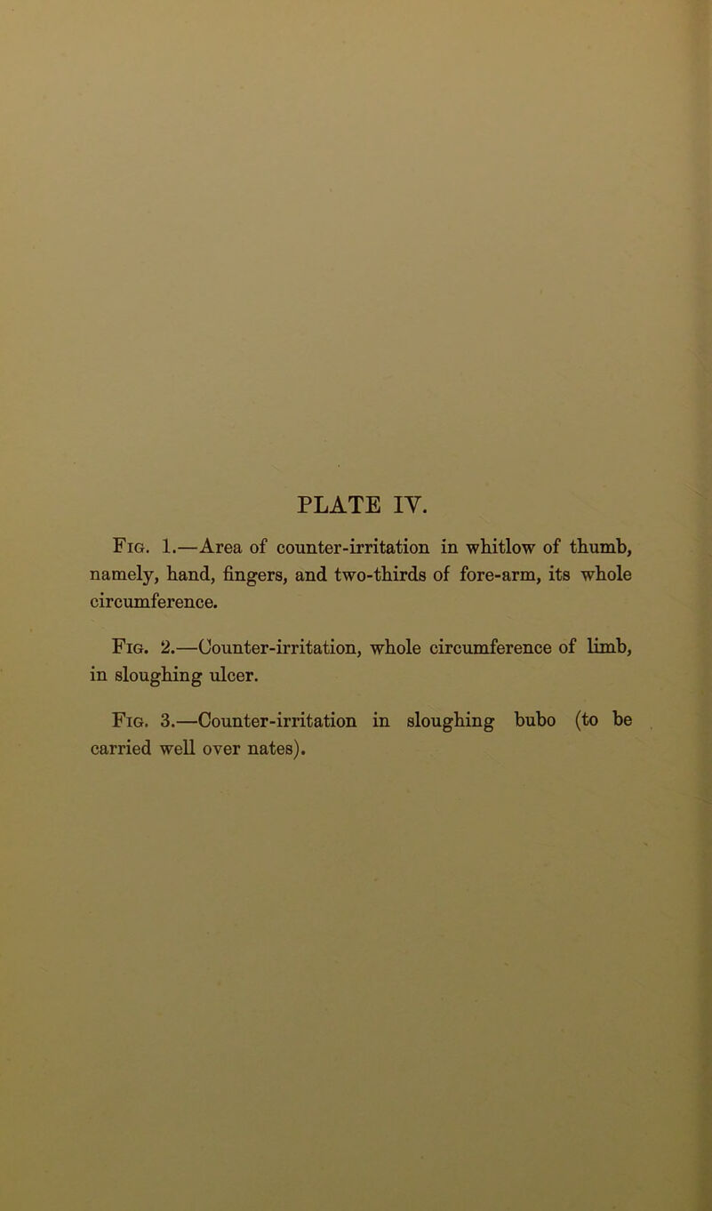 Fig. 1.—Area of counter-irritation in whitlow of thumb, namely, hand, fingers, and two-thirds of fore-arm, its whole circumference. Fig. 2.—Counter-irritation, whole circumference of limb, in sloughing ulcer. Fig. 3.—Counter-irritation in sloughing bubo (to be carried well over nates).