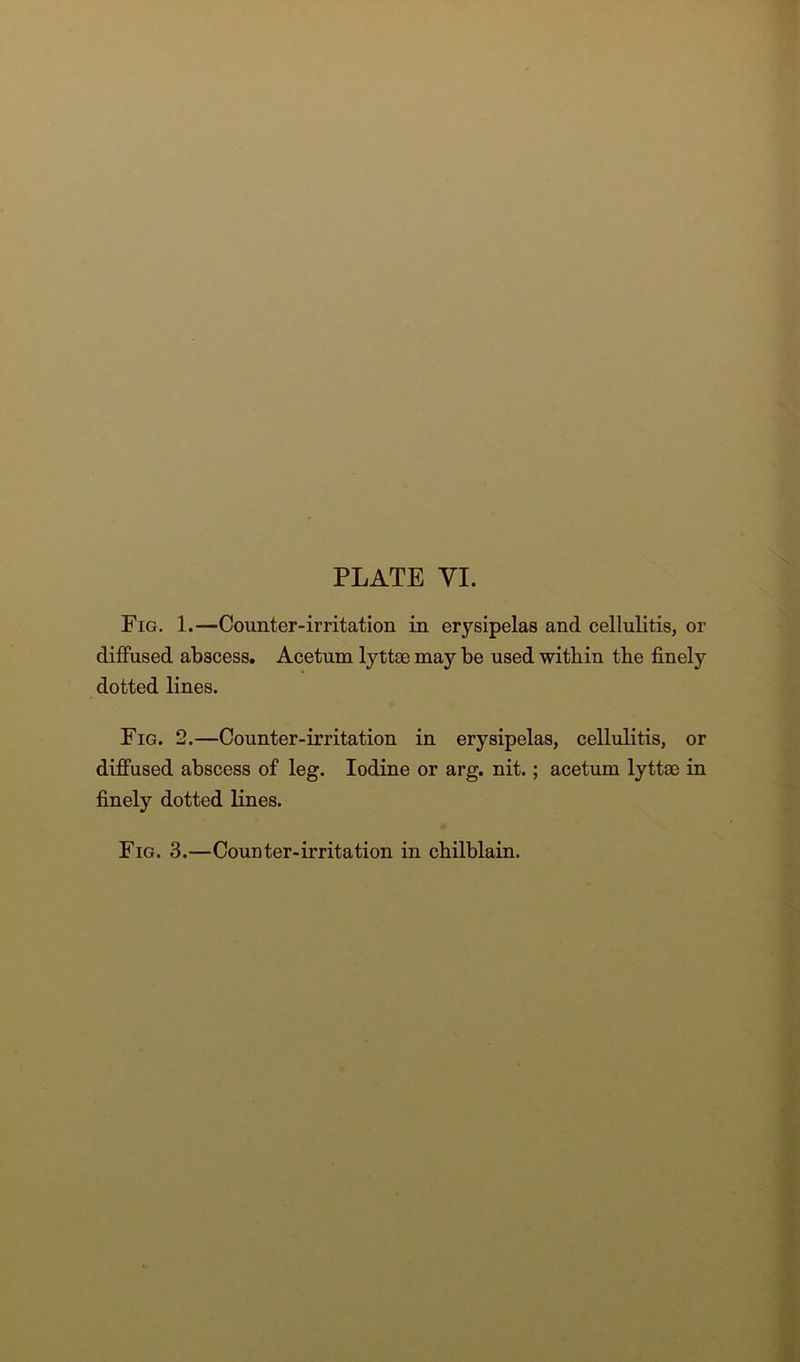 Fig. 1.—Counter-irritation in erysipelas and cellulitis, or diffused abscess. Acetum lyttse may be used within the finely dotted lines. Fig. 2.—Counter-irritation in erysipelas, cellulitis, or diffused abscess of leg. Iodine or arg. nit.; acetum lyttee in finely dotted lines. Fig. 3.—Counter-irritation in chilblain.