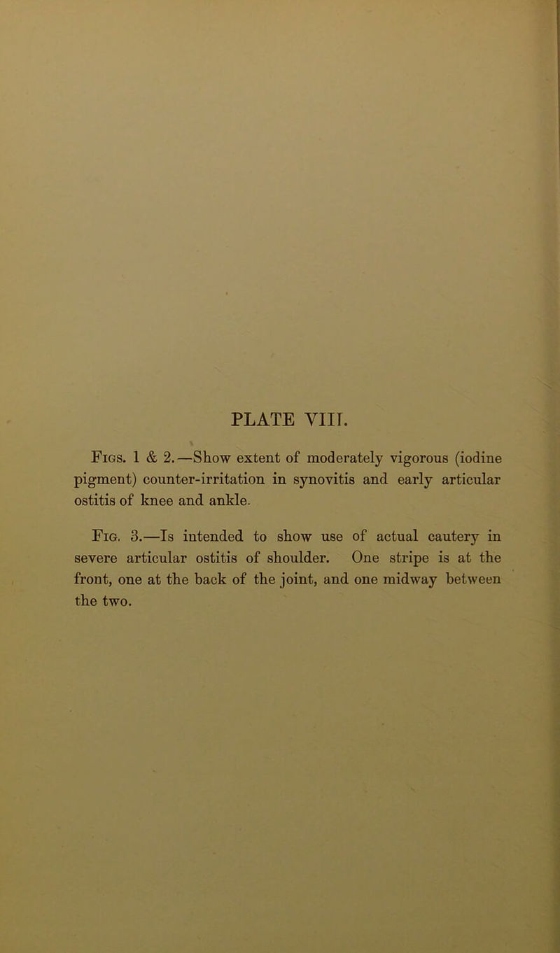 PLATE VIIT. Figs. 1 & 2.—Show extent of moderately vigorous (iodine pigment) counter-irritation in synovitis and early articular ostitis of knee and ankle. Fig, 3.—Is intended to show use of actual cautery in severe articular ostitis of shoulder. One stripe is at the front, one at the back of the joint, and one midway between the two.