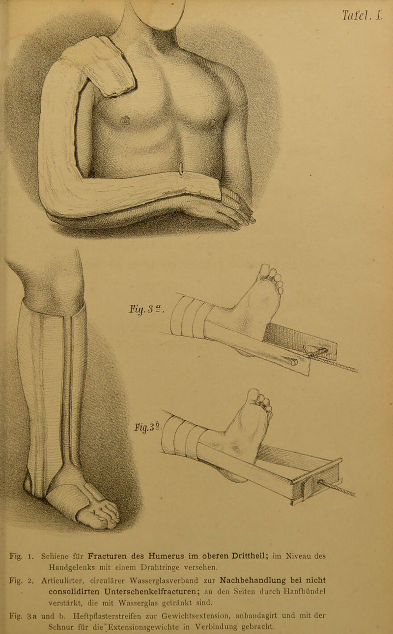 Tafel L Fig. l. Schiene für Fracturen des Humerus im oberen Drittheil; im Niveau des Handgelenks mit einem Drahtringe versehen. consolidirten Unterschenkelfracturen; an den Seiten durch Hanfbündel verstärkt, die mit Wasserglas getränkt sind. Fig. 3a und b. Heftpflasterstreifen zur Gewichtsextension, anbandagirt und mit der Schnur für die”Extensionsgcvvichte in Verbindung gebracht. hg. 3^