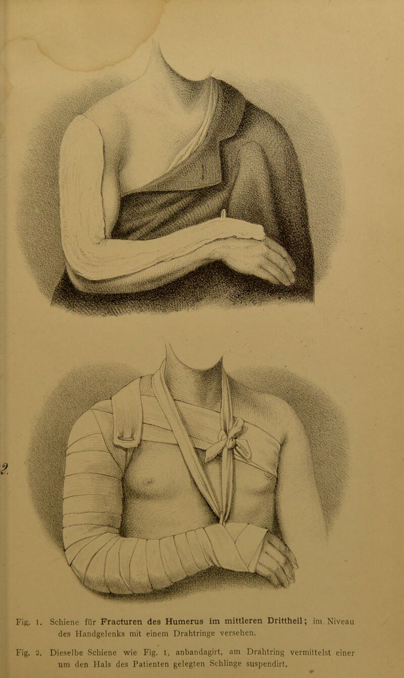 des Handgelenks mit einem Drahtringe versehen. Fig. 2. Dieselbe Schiene wie Fig. 1., anbandagirt, am Drahtring vermittelst einer um den Hals des Patienten gelegten Schlinge suspendirt.