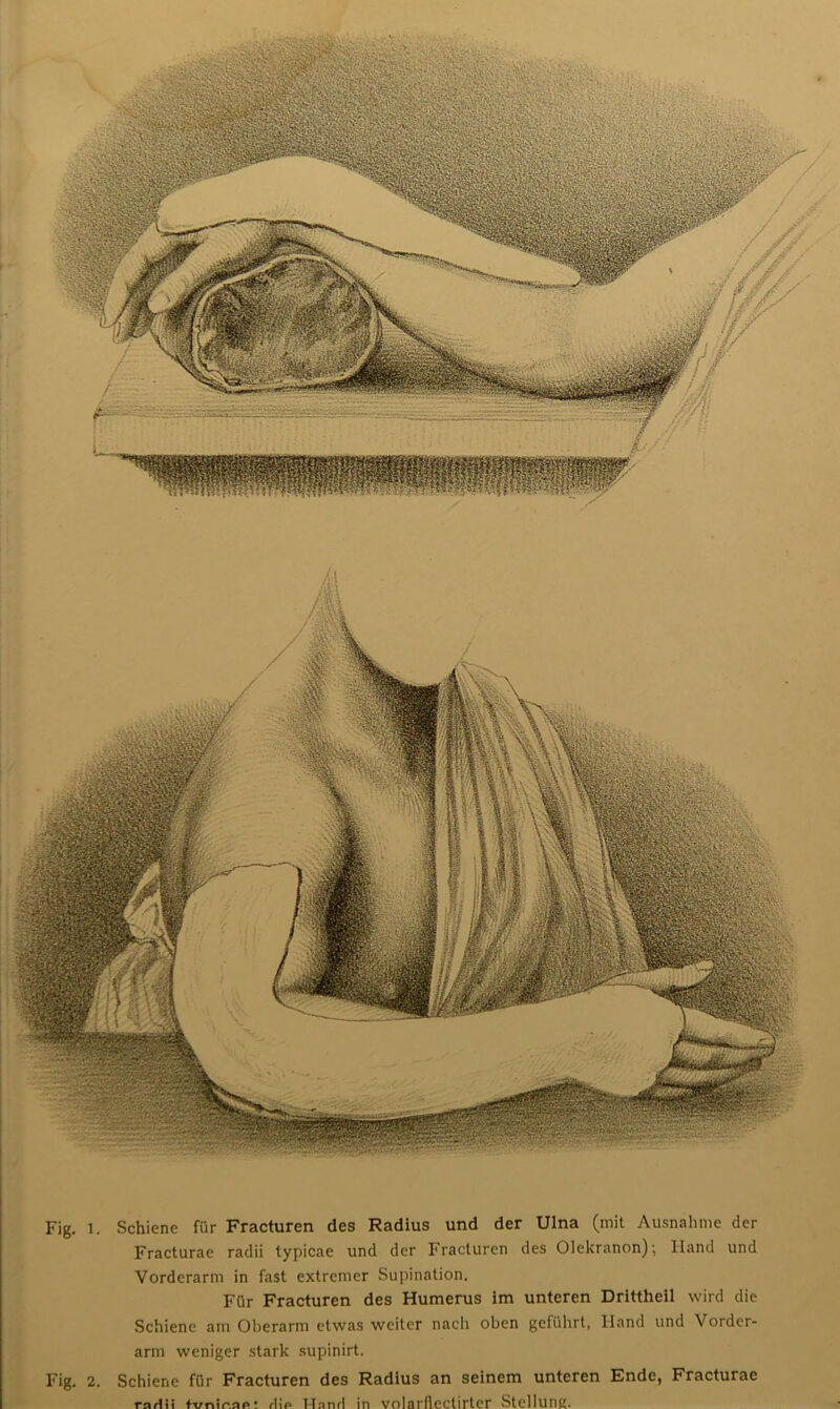 Fig. l. Schiene für Fracturen des Radius und der Ulna (mit Ausnahme der Fracturae radii typicae und der Fracturen des Olekranon); Hand und Vorderarm in fast extremer Supination. Für Fracturen des Humerus im unteren Drittheil wird die Schiene am Oberarm etwas weiter nach oben geführt, Hand und Vorder- arm weniger stark supinirt. Fig. 2. Schiene für Fracturen des Radius an seinem unteren Ende, Fracturae rnrtii fvnirap! rlir* Ilnnfl in Volai'fieclirtor Stellung.