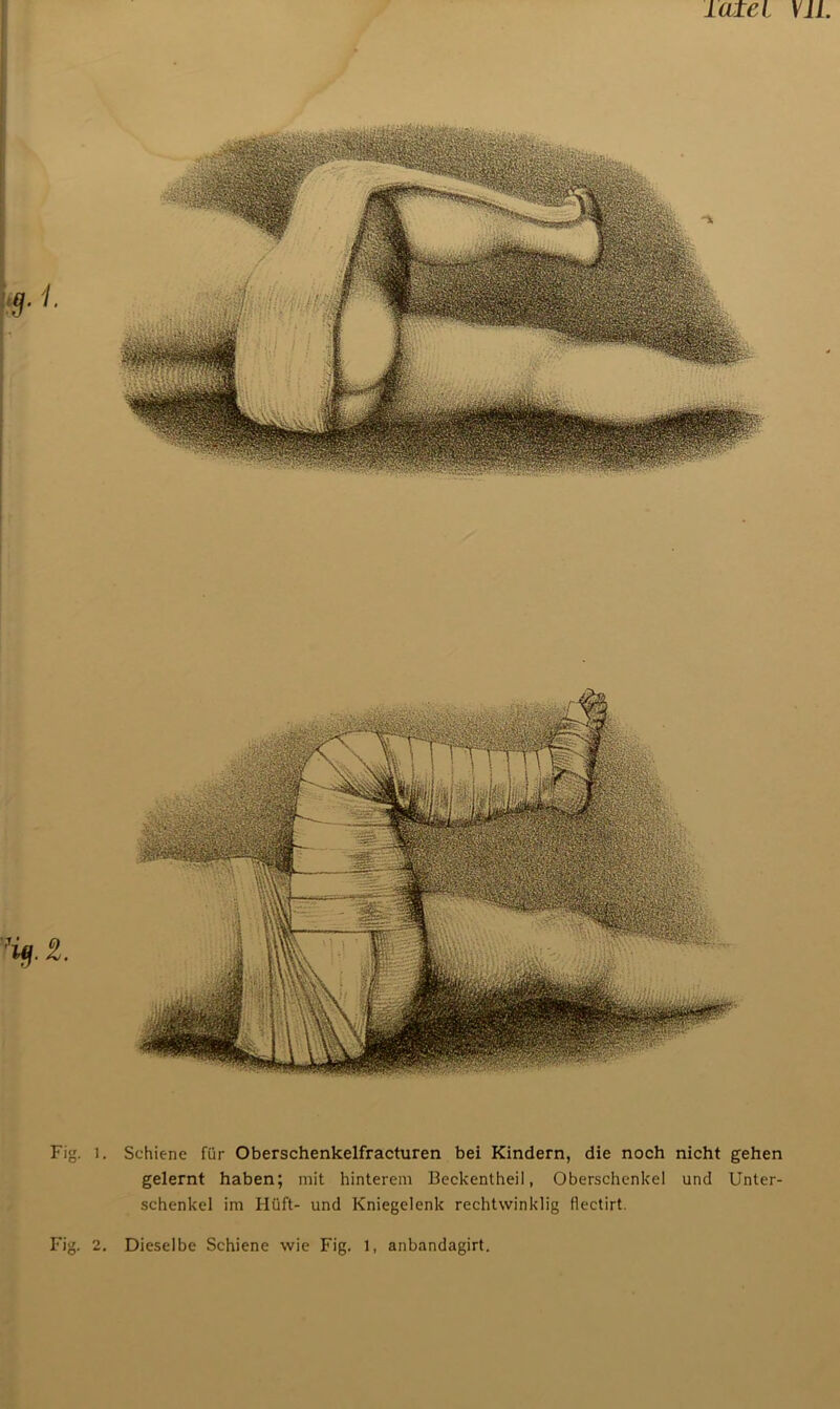 lotet XU Fig. l. Schiene für Oberschenkelfracturen bei Kindern, die noch nicht gehen gelernt haben; mit hinterem Beckentheil, Oberschenkel und Unter- schenkel im Hüft- und Kniegelenk rechtwinklig (lectirt. Fig. 2. Dieselbe Schiene wie Fig. 1, anbandagirt.