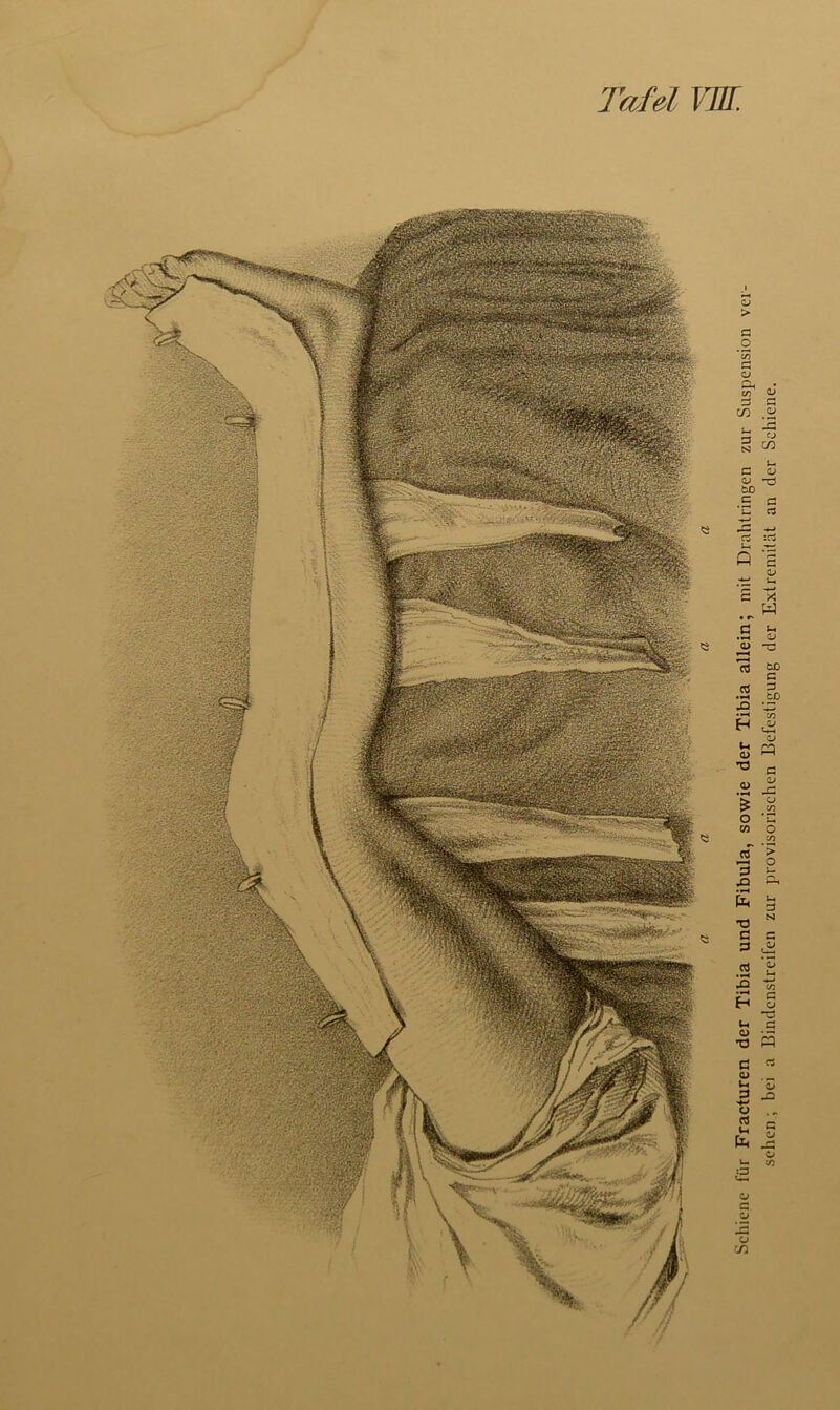 Tafel 17//. Schiene für Fracturen der Tibia und Fibula, sowie der Tibia allein; mit Drahtringen zur Suspension ver- sehen ; bei a Bindenstreifen zur provisorischen Befestigung der Extremität an der Schiene.