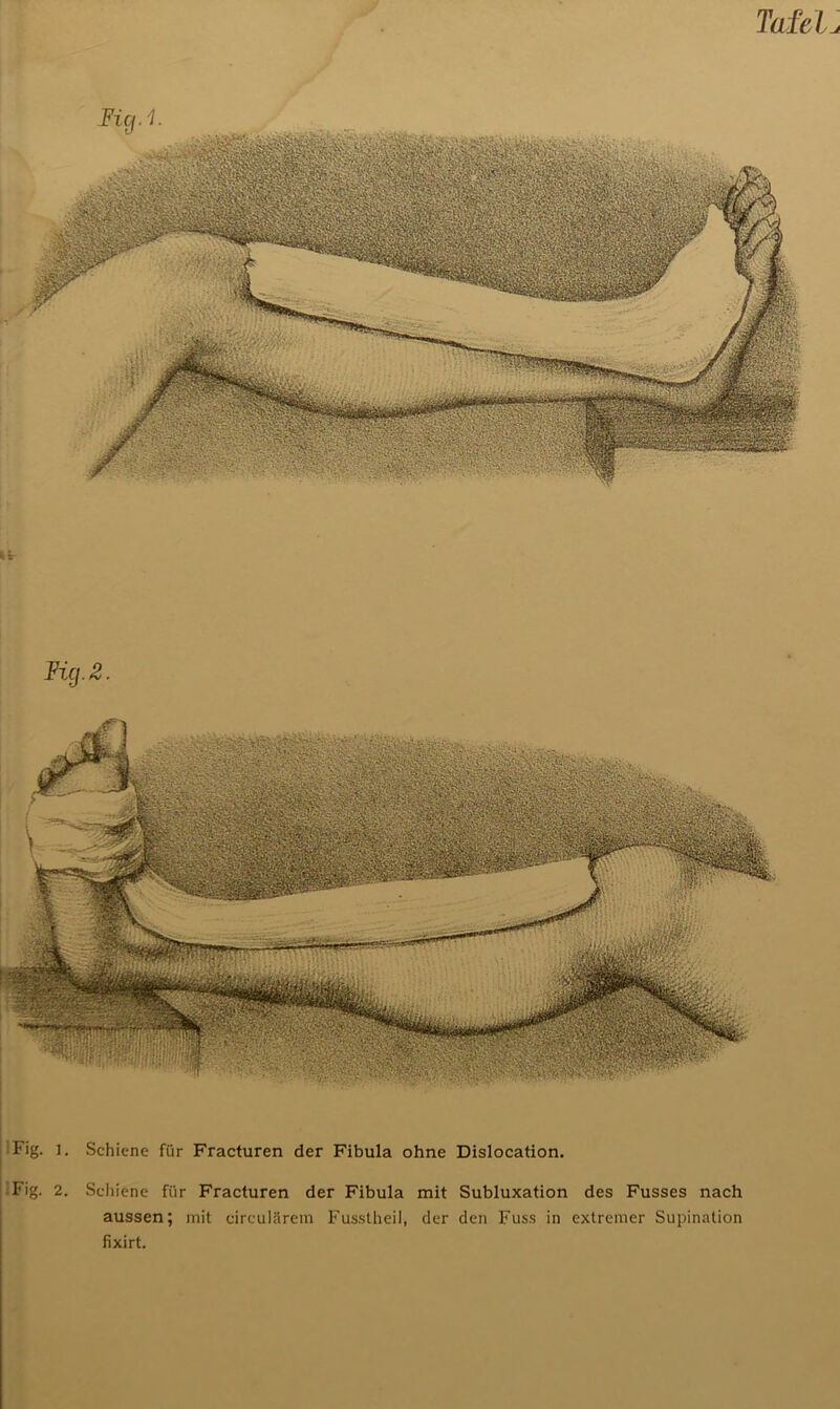 Tafelu Fig. 2. Fig. l. Schiene für Fracturen der Fibula ohne Dislocation. Fig. 2. Schiene für Fracturen der Fibula mit Subluxation des Fusses nach aussen; mit circularem Fusstheil, der den Fuss in extremer Supination fixirt.