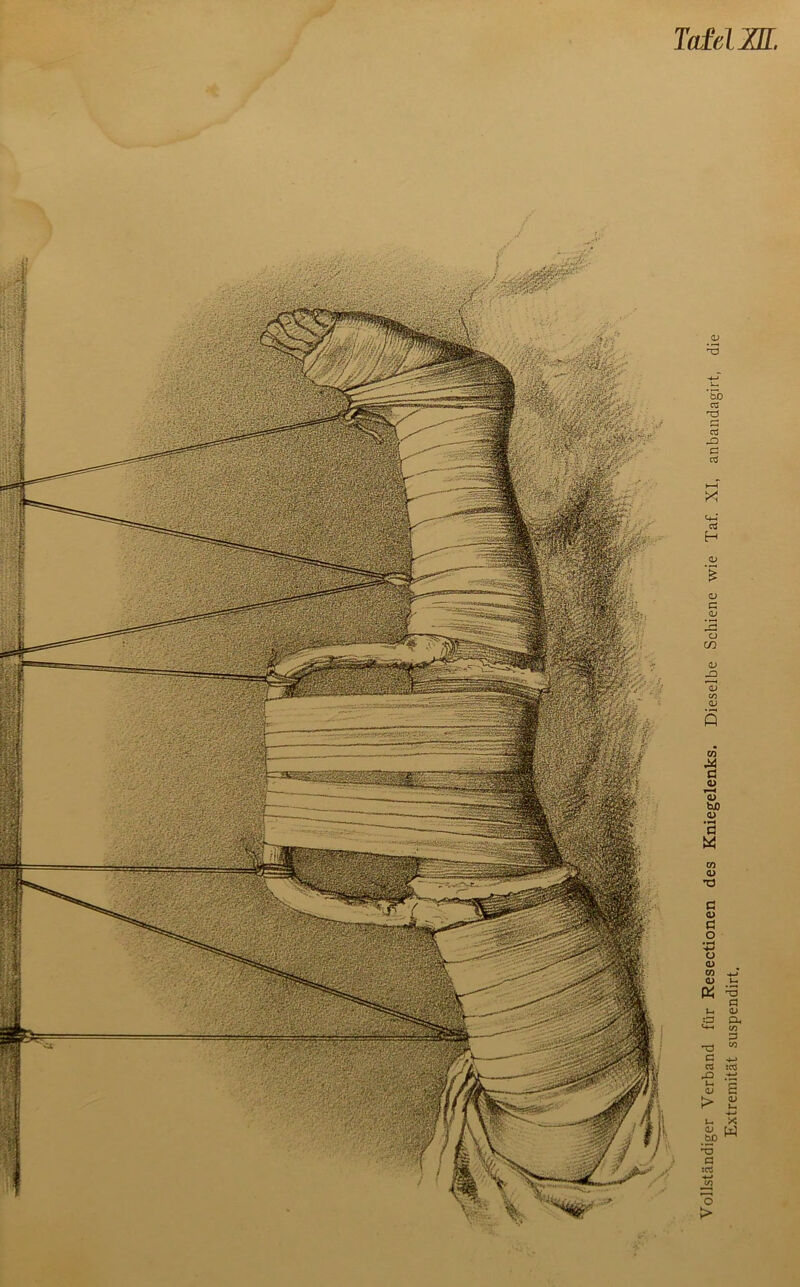 Tafel XU. Vollständiger Verband für Resectionen des Kniegelenks. Dieselbe Schiene wie Taf. XI, anbandagirt, die Extremität suspendirt.