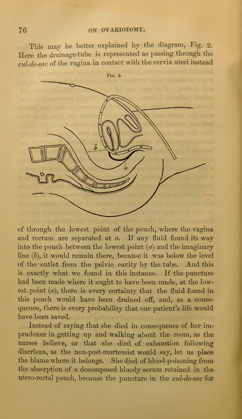 This may be better explained by the diagram, Fig. 2. Here the drainage-tube is represented as passing through the cul-de-sac of the vagina in contact with the cervix uteri instead Fig. 2. of through the lowest point of the pouch, where the vagina and rectum are separated at a. If any fluid found its way into the pouch between the lowest point (a) and the imaginary line (5), it would remain there, because it was below the level of the - outlet from the pelvic cavity by the tube. And this is exactly what we found in this instance. If the puncture had been made where it ought to have been made, at the low- est point (a), there is every certainty that the fluid found in this pouch would have been drained off, and, as a conse- quence, there is every probability that our patient’s life would have been saved. Instead of saying that she died in consequence of her im- prudence in getting up and walking about the room, as the nurses believe, or that she died of exhaustion following diarrhoea, as the non-post-mortemist would say, let us place the blame where it belongs. She died of blood-poisoning from the absorption of a decomposed bloody serum retained in the utero-rectal pouch, because the puncture in the cul-de-sac for