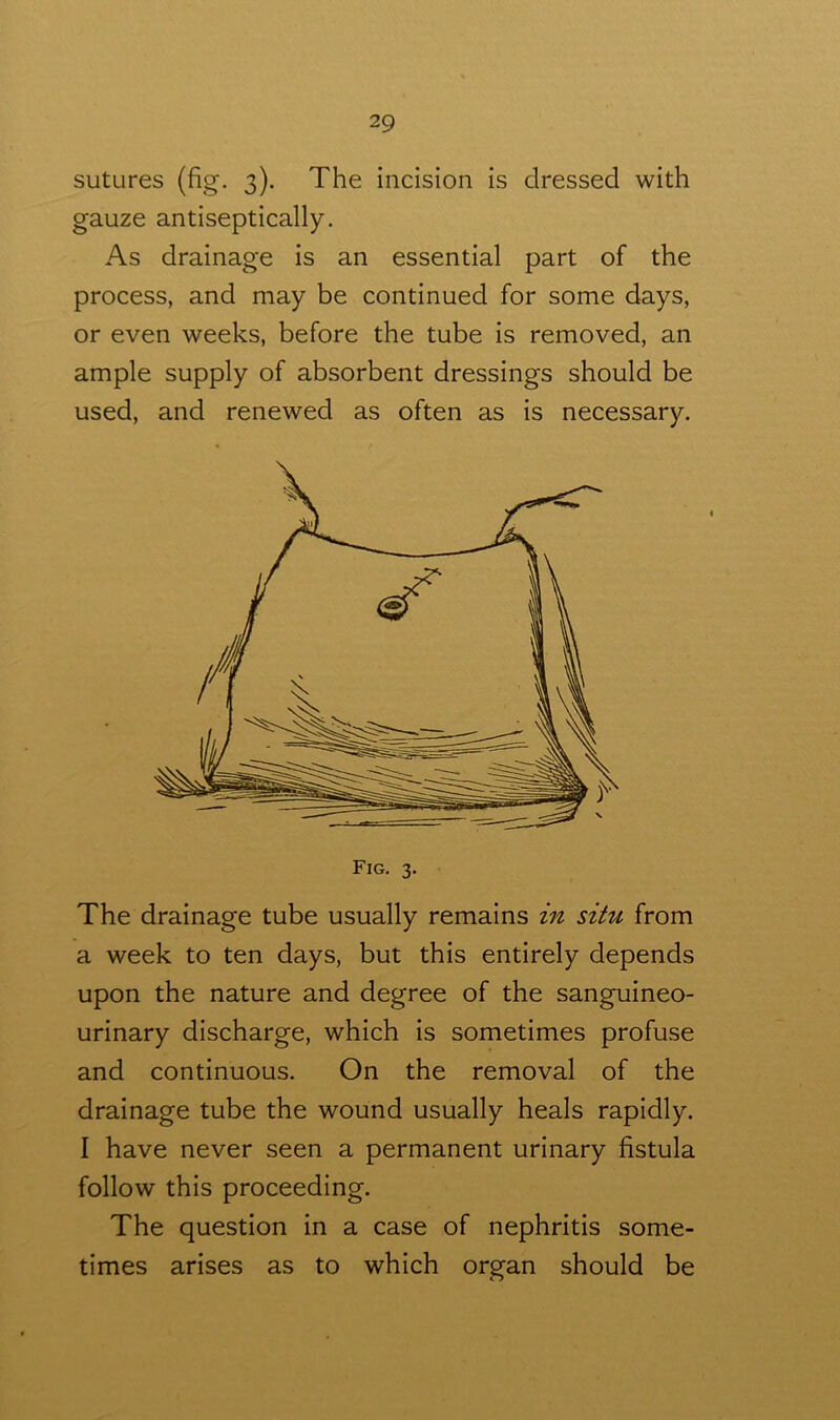 sutures (fig. 3). The incision is dressed with gauze antiseptically. As drainage is an essential part of the process, and may be continued for some days, or even weeks, before the tube is removed, an ample supply of absorbent dressings should be used, and renewed as often as is necessary. The drainage tube usually remains in situ from a week to ten days, but this entirely depends upon the nature and degree of the sanguineo- urinary discharge, which is sometimes profuse and continuous. On the removal of the drainage tube the wound usually heals rapidly. I have never seen a permanent urinary fistula follow this proceeding. The question in a case of nephritis some- times arises as to which organ should be Fig. 3.