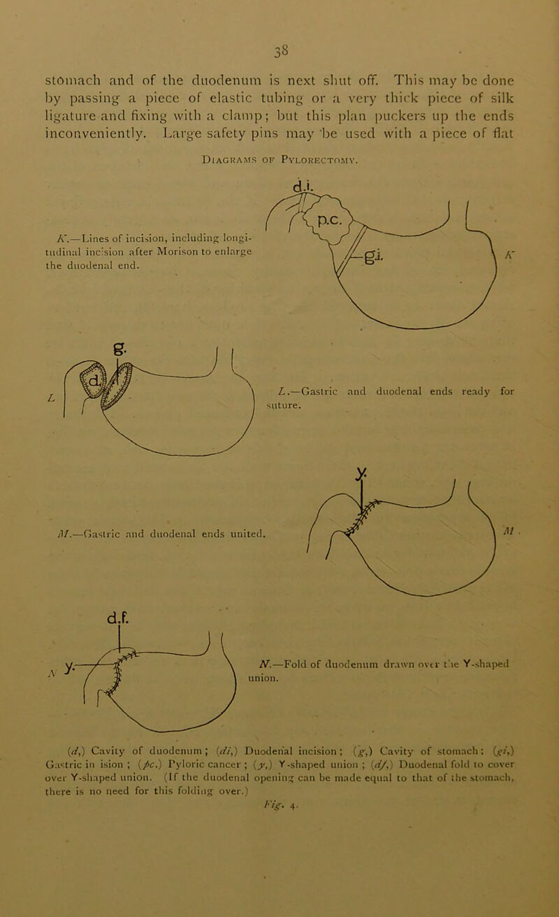 by passing a piece of elastic tubing or a v'ery thick piece of silk ligature and fixing with a clamp; but this plan puckers up the ends inconveniently. Large safety pins may 'be used with a piece of flat Diagrams of Pylorectomv. {d,) Cavily of duodenum; {<//,) Duodenal incision; (^,) Cavity of stomach: G;istric in ision ; (/c.) Pyloric cancer ; (_y,) Y-shaped union; {d/,) Duodenal fold to cover over Y-shaped union. (If the duodenal openinj; can be made ecpial to that of the stom.ach. there is no need for this folding over.) 4.