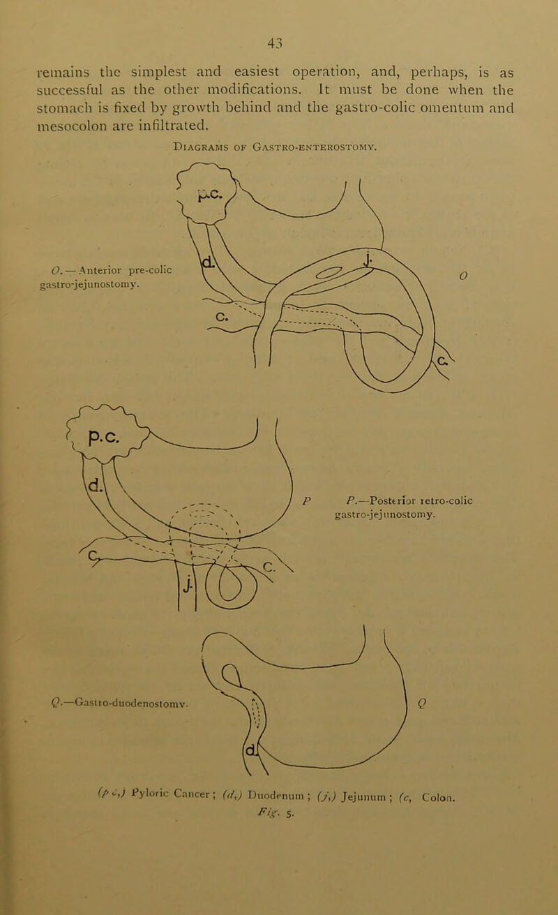 remains the simplest and easiest operation, and, perhaps, is as successful as the other modifications. It must be done when the stomach is fi.xed by growth behind and the gastro-colic omentum and mesocolon are infiltrated. Diagrams of Gastro-enterostomy. P P.—Posttrlor retro-colic gastro-jejiinostomy. D. — .Anterior pre-colic gastro-jejunostomy. (P •->/ Pyloric Cancer ; (d,) Duodenum ; (j,) Jejunum ; (c, P‘.<- S- Q-—Gasiio-duodenostomv. Colon.