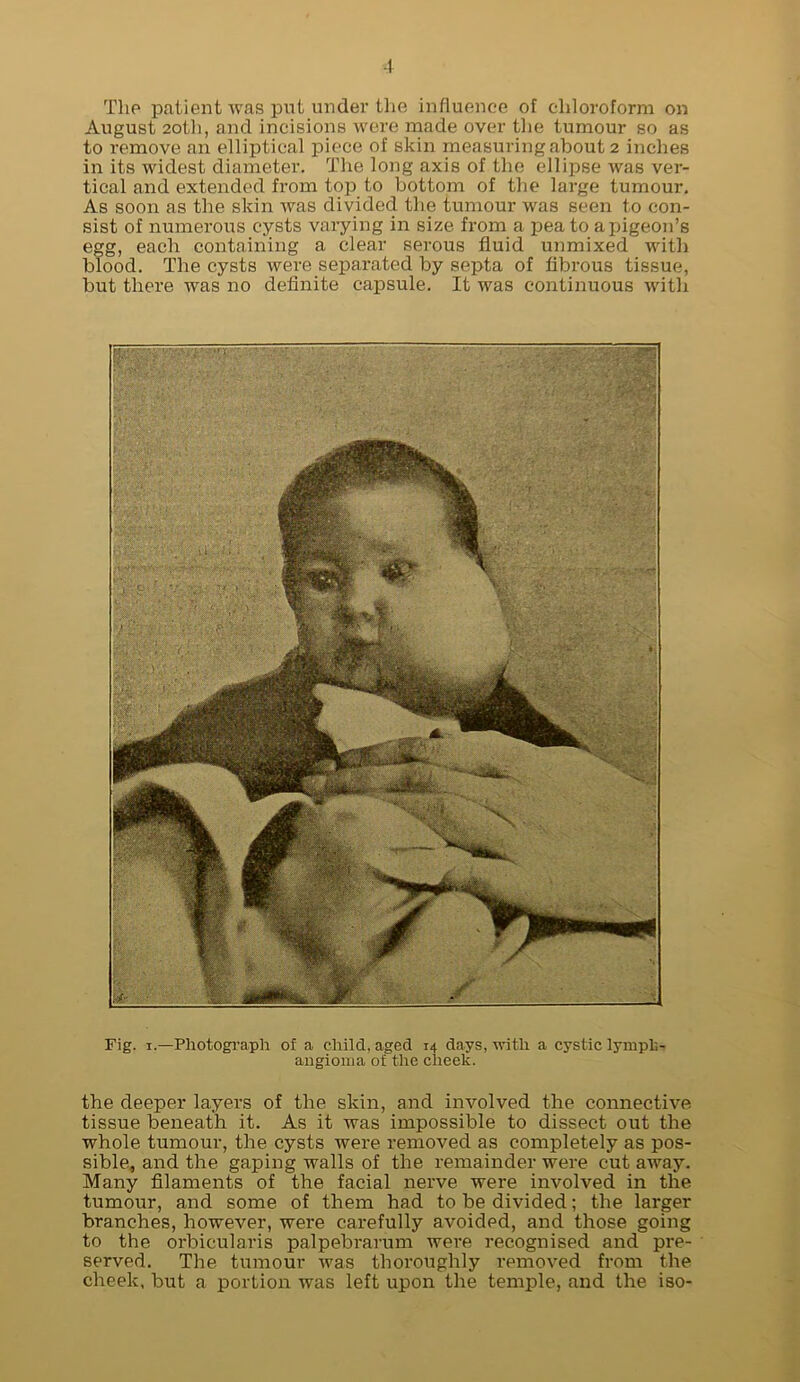 The patient was put undei' the influenee of chloroform on August 2oth, and incisions Avero made over the tumour so as to remove an elliptical piece of skin measuring about 2 inches in its widest diameter. The long axis of the ellipse was ver- tical and extended from toj) to bottom of the large tumour. As soon as the skin Avas divided the tumour was seen to con- sist of numerous cysts varying in size from a pea to a pigeon’s egg, each containing a clear serous fluid unmixed Avith blood. The cysts were separated by septa of fibrous tissue, but there was no definite capsule. It was continuous Avith Fig. I.—Photogi’aph of a child, aged 14 days, Avith a cystic lymph- angioma of the cheek. the deeper layers of the skin, and involved the connective tissue beneath it. As it was impossible to dissect out the whole tumour, the cysts were removed as completely as pos- sible, and the gaping walls of the remainder were cut away. Many filaments of the facial nerve were involved in the tumour, and some of them had to be divided; the larger branches, however, were carefully avoided, and those going to the orbicularis palpebrarum were recognised and pre- served. The tumour Avas thoroughly removed from the cheek, but a portion was left upon the temple, and the iso-