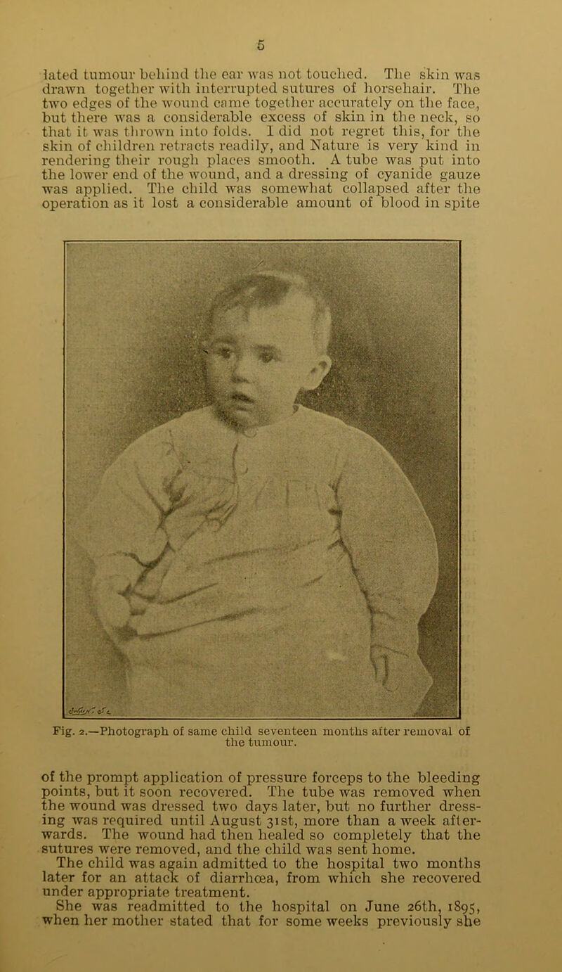 lated tumour behind the ear was not touched. The skin wa.g drawn together with interrupted sutures of horsehair. The two edges of the wound came together accurately on the face, but there was a considerable excess of skin in the neck, so that it was thrown into folds. 1 did not regret this, for the skin of children retracts readily, and Nature is very kind in rendering their rough places smooth. A tube was put into the lower end of the wound, and a dressing of cyanide gauze was applied. The child was somewhat collapsed after the operation as it lost a considerable amount of blood in spite Fig. 2.—Photograph of same child seventeen months after removal of the tumour. of the prompt application of pressure forceps to the bleeding points, but it soon recovered. The tube was removed when the wound was dressed two days later, but no further dress- ing was required until August 31st, more than a week after- wards. The wound had then healed so completely that the sutures were removed, and the child was sent home. The child was again admitted to the hospital two months later for an attack; of diarrhoea, from which she recovered under appropriate treatment. She was readmitted to the hospital on June 26th, 1895, when her mother stated that for some weeks previously she
