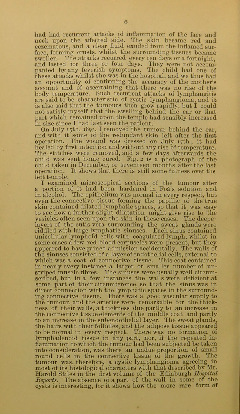 G had had recun-ent attacks of inflammation of the face and neck upon the affected side. The skin became red and eczematous, and a clear fluid exuded from the inflamed sur- face, forming crusts, whilst the surrounding tissues became swollen. The attacks recurred every ten days or a fortnight, and lasted for three or four days. They were not accom- panied by any feverish symptoms. The child had one of these attacks whilst she was in the hospital, and we thus had an opportunity of conflrrning the accuracy of the mother’s account and of ascertaining that there was no rise of the body temperature. Such recurrent attacks of lymphangitis are said to be characteristic of cystic lymphangioma, and it is also said that the tumours then grow rapidly, but I could not satisfy myself that the swelling behind the ear or that part which remained upon the temple had sensibly increased in size since I had last seen the patient. On July 15th, 1895, I removed the tumour behind the ear, and with it some of the redundant skin left after the first operation. The wound was dressed on July 17th; it had healed by first intention and without any rise of temperature. The stitches were removed, and a few days afterwards the child was sent home cured. Fig. 2 is a photograph of the child taken in December, or seventeen months after the last operation. It shows that there is still some fulness over thfi left temple. I examined microscopical sections of the tumour after a portion of it had been hardened in Fok’s solution and in alcohol. The epithelium was normal in eveiy respect, but even the connective tissue forming the papillae of the true skin contained dilated lymphatic spaces, so that it was easy to see how a further slight dilatation might give rise to the vesicles often seen upon the skin in these cases. The deepe' layers of the cutis vera surrounding the sweat glands were riddled with large lymphatic sinuses. Each sinus contained unicellular lymphoid cells with coagulated lymph, whilst in some cases a few red blood corpuscles were present, but they appeared to have gained admission accidentally. The walls of the sinuses consisted of a layer of endothelial cells, external to which was a coat of connective tissue. This coat contained in nearly every instance, a larger or smaller number of un- striped muscle fibres. The sinuses were usually well cii'cum- scribed, but in a few instances the walls were deficient at some part of their circumference, so that the sinus was in direct connection with the lymphatic spaces in the surround- ing connective tissue. There was a good vascular supply to the tumour, and the arteries were remarkable for the thick- ness of their walls, a thickness due partly to an increase in the connective tissue elements of the middle coat and partly to an increase in the subendothelial layer. The sweat glands, the hairs with their follicles, and the adipose tissue appeared to be normal in every respect. There was no formation of lymphadenoid tissue in any part, nor, if the repeated in- flammation to which the tumour had been subjected be taken into consideration, was there an undue proportion of small round cells in the connective tissue of the growth. The tumour was, therefore, a cystic lymphangioma agreeing in most of its histological characters with that described by Mr. Harold Stiles in the first volume of the Edinburgh Hospital Reports. The absence of a part of the wall in some of the cysts is interesting, for it shows how the more rare form of