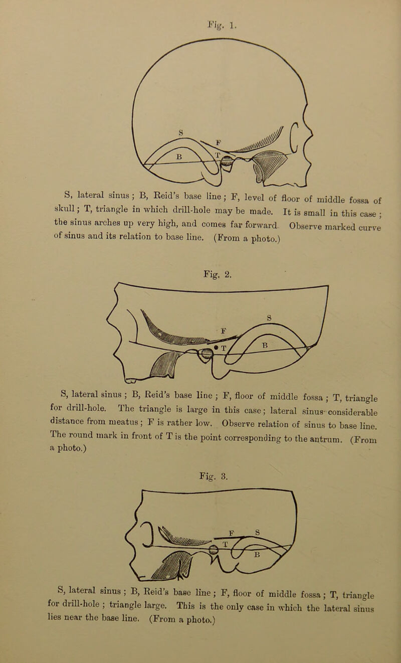 S, lateral sinus; B, Reid’s base line; F, level of floor of middle fossa of skull; T, triangle in which drill-hole may be made. It is small in this case ; the sinus arches up very high, and comes far forward Observe marked curve' of sinus and its relation to base line. (From a photo.) Fig. 2. S, lateral sinus ; B, Reid’s base line ; F, floor of middle fossa ; T, triangle for drill-hole. The triangle is large in this case; lateral sinus- considerable distance from meatus; F is rather low. Observe relation of sinus to base line. The round mark in front of T is the point corresponding to the antrum. (From a photo.) Fig. 3. S, lateral sinus ; B, Reid’s base line; F, floor of middle fossa; T, triangle for drill-hole ; triangle large. This is the only case in which the lateral sinus lies near the base line. (From a photo.)