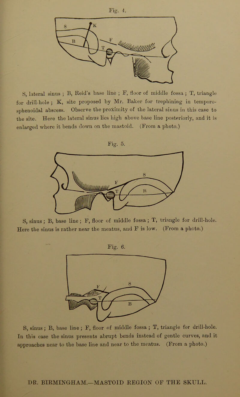 S, lateral sinus ; B, Reid’s base line ; F, floor of middle fossa; T, triangle for drill-hole ; K, site proposed by Mr. Baker for trephining in temporo- sphenoidal abscess. Observe the proximity of the lateral sinus in this case to the site. Here the lateral sinus lies high above base line posteriorly, and it is enlarged where it bends down on the mastoid. (From a photo.) Fig. 5. S, sinus; B, base line ; F, floor of middle fossa ; T, triangle for drill-hole. Here the sinus is rather near the meatus, and F is low. (From a photo.) Fig. 6. S, sinus ; B, base line ; F, floor of middle fossa ; T, triangle for drill-hole. In this case the sinus presents abrupt bends instead of gentle curves, and it approaches near to the base line and near to the meatus. (From a photo.) DR. BIRMINGHAM.—MASTOID REGION OF THE SKULL.