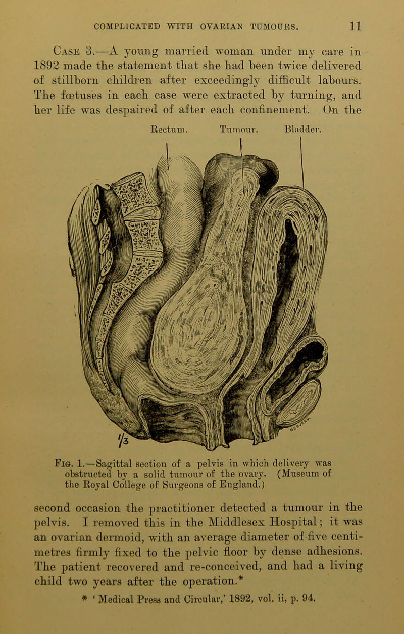 Case 3.—A young married woman under my care in 1892 made the statement that she had been twice delivered of stillborn children after exceedingly difficult labours. The foetuses in each case were extracted by turning, and her life was despaired of after each confinement. On the Rectiun. Tntnour. Bladder. Fig. 1.—Sagittal section of a pelvis in which delivery was obstructed by a solid tumour of the ovary. (Museum of the Royal College of Surgeons of England.) second occasion the practitioner detected a tumour in the pelvis. I removed this in the Middlesex Hosjiital; it was an ovarian dermoid, with an average diameter of five centi- metres firmly fixed to the pelvic floor by dense adhesions. The patient recovered and re-conceived, and had a living child two years after the operation.* * ‘ Medical Press and Circular,’ 1892, vol, ii, p. 94.